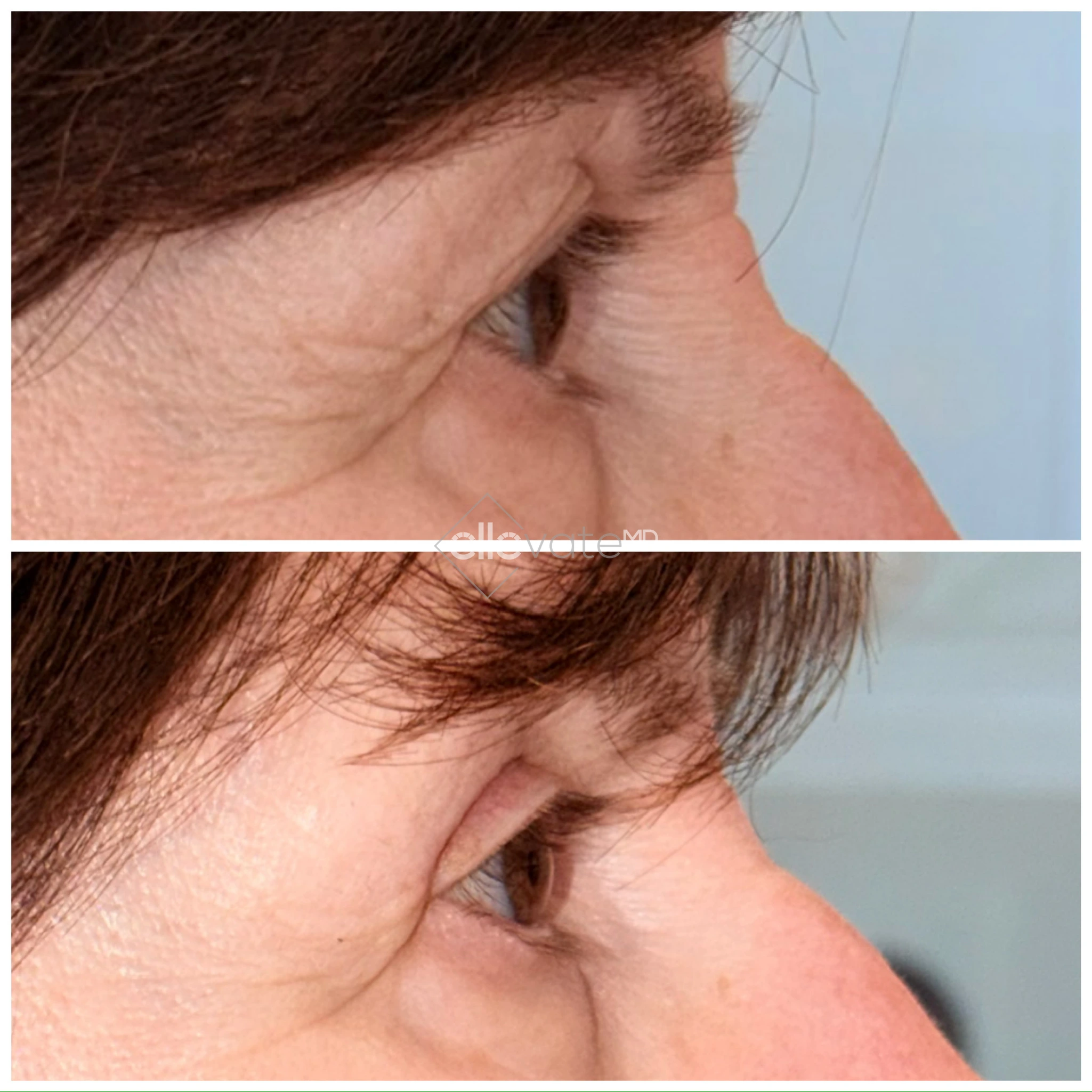 Before and after profile view of upper lid showing improved elevation and eye opening