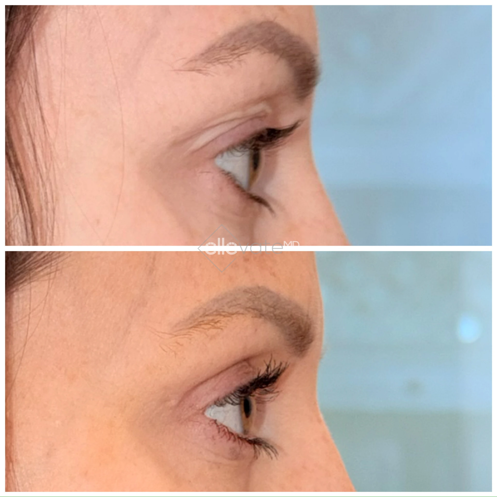 Before and after profile view of upper eyelid with enhanced lift and more defined lid crease