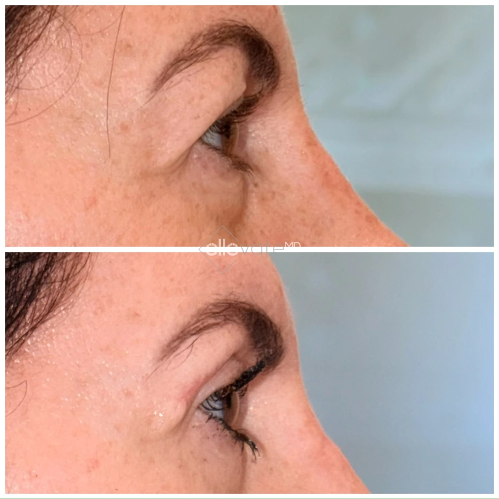 Before and after profile view demonstrating upper lid lift results with improved eyelid contour