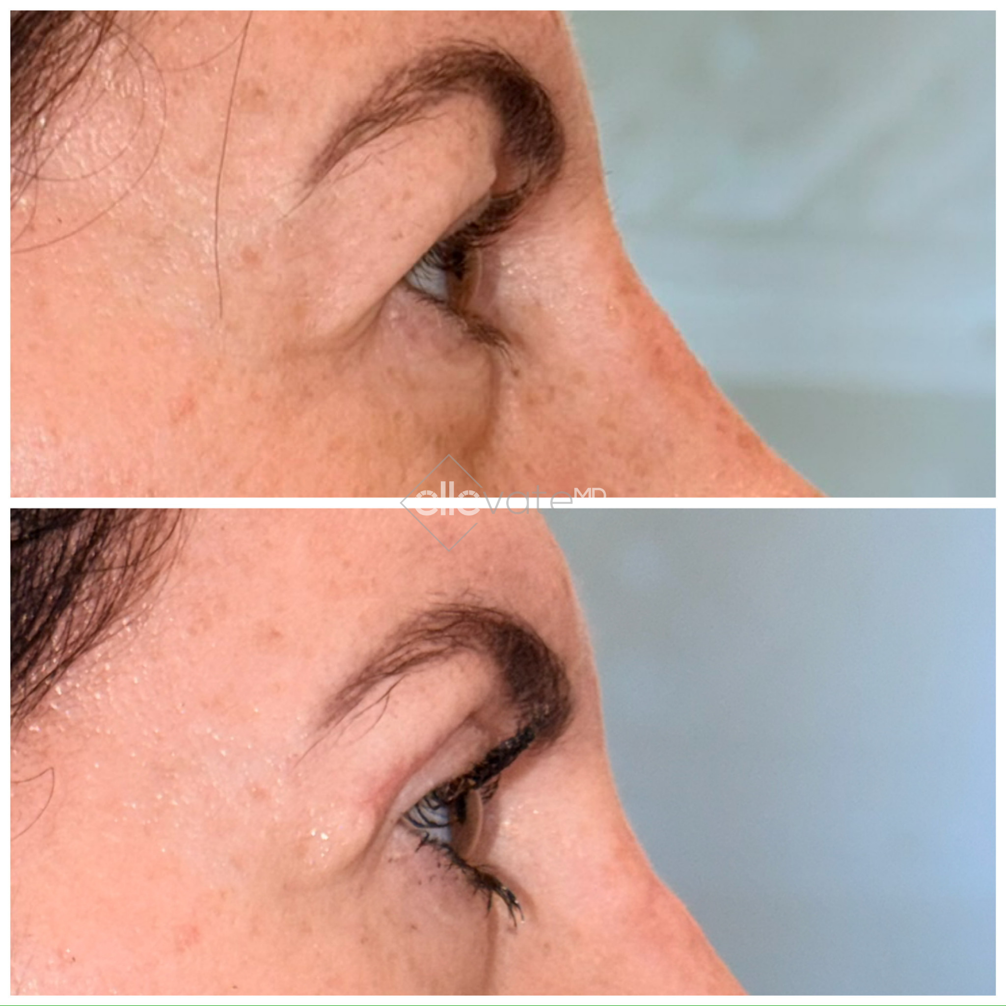 Before and after profile view demonstrating upper lid lift results with improved eyelid contour