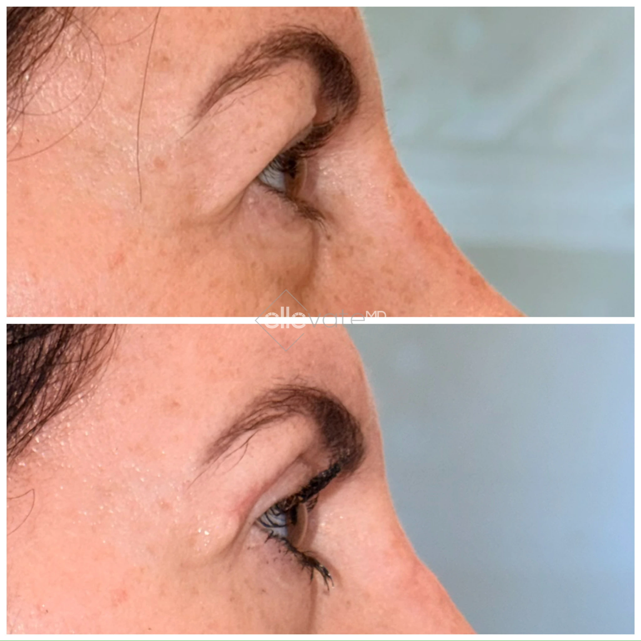 Before and after profile view demonstrating upper lid lift results with improved eyelid contour