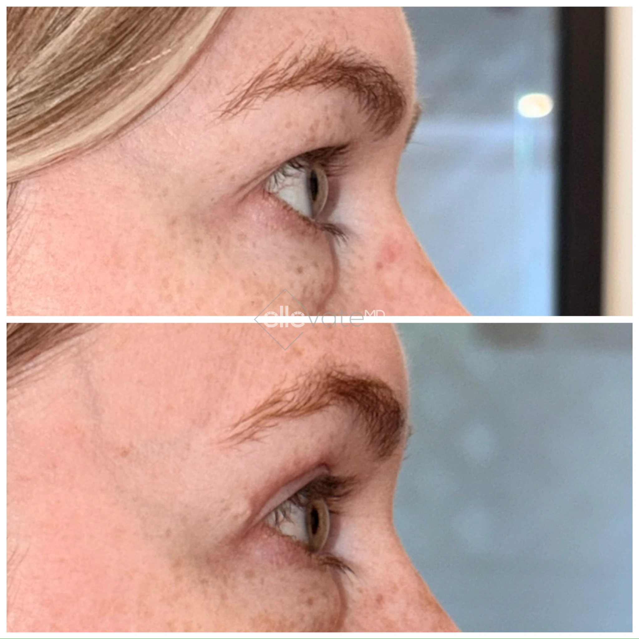 Before and after profile view of upper eyelid lift showing improved eyelid position