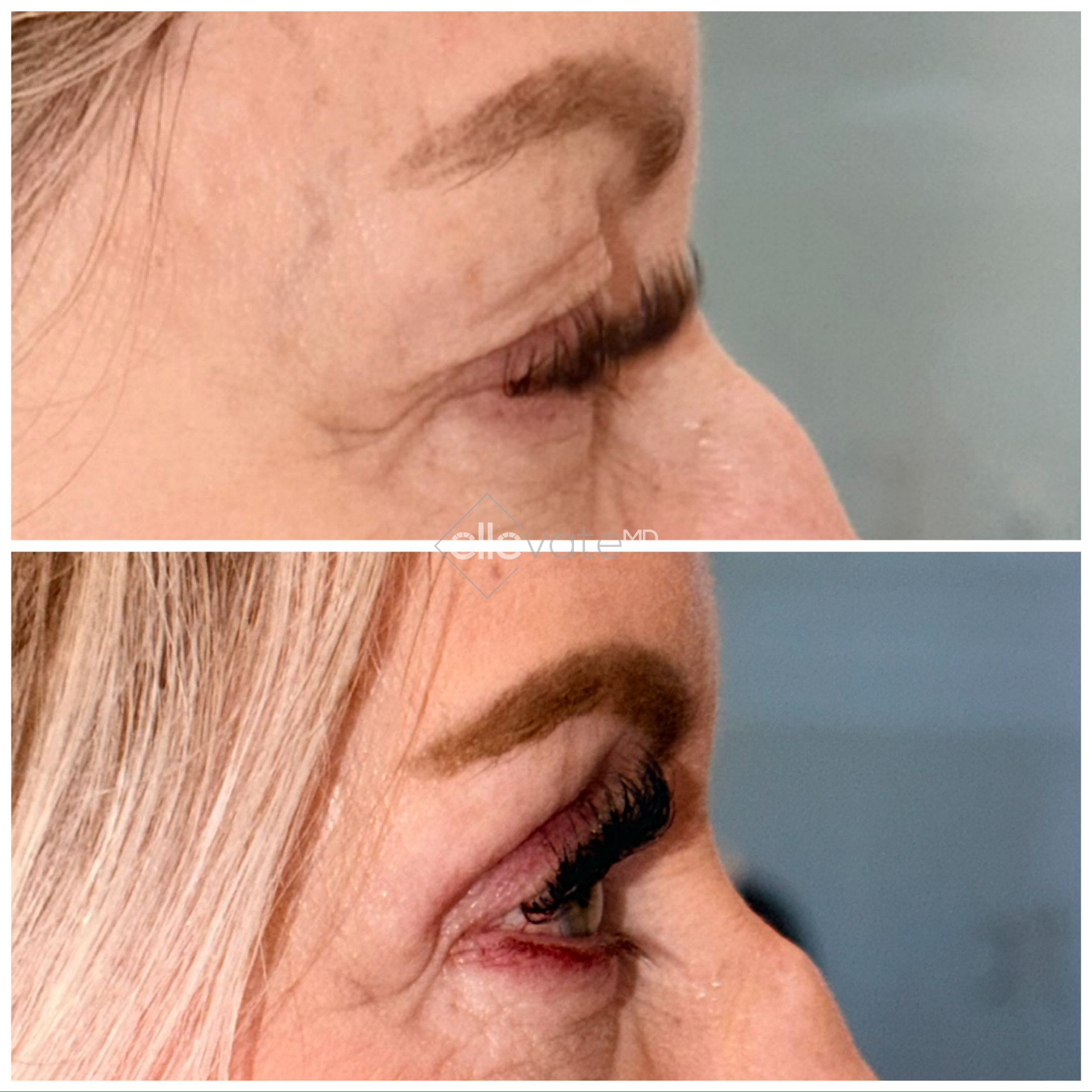Before and after profile view of upper eyelid lift with enhanced eyelid contour