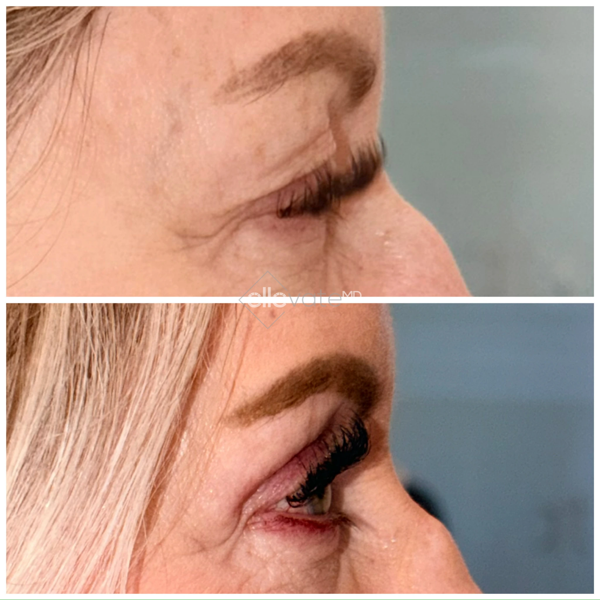 Before and after profile view of upper eyelid lift with enhanced eyelid contour