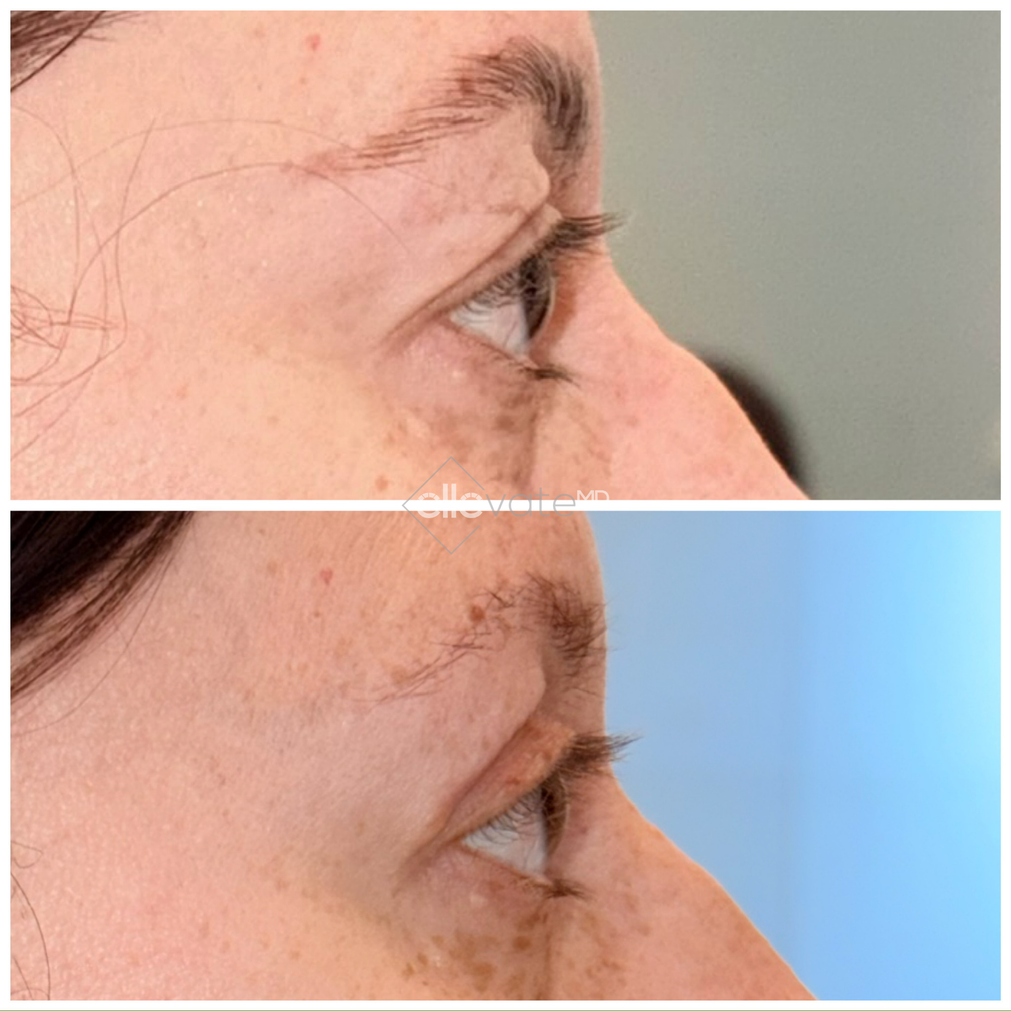 Before and after profile view of upper eyelid lift results