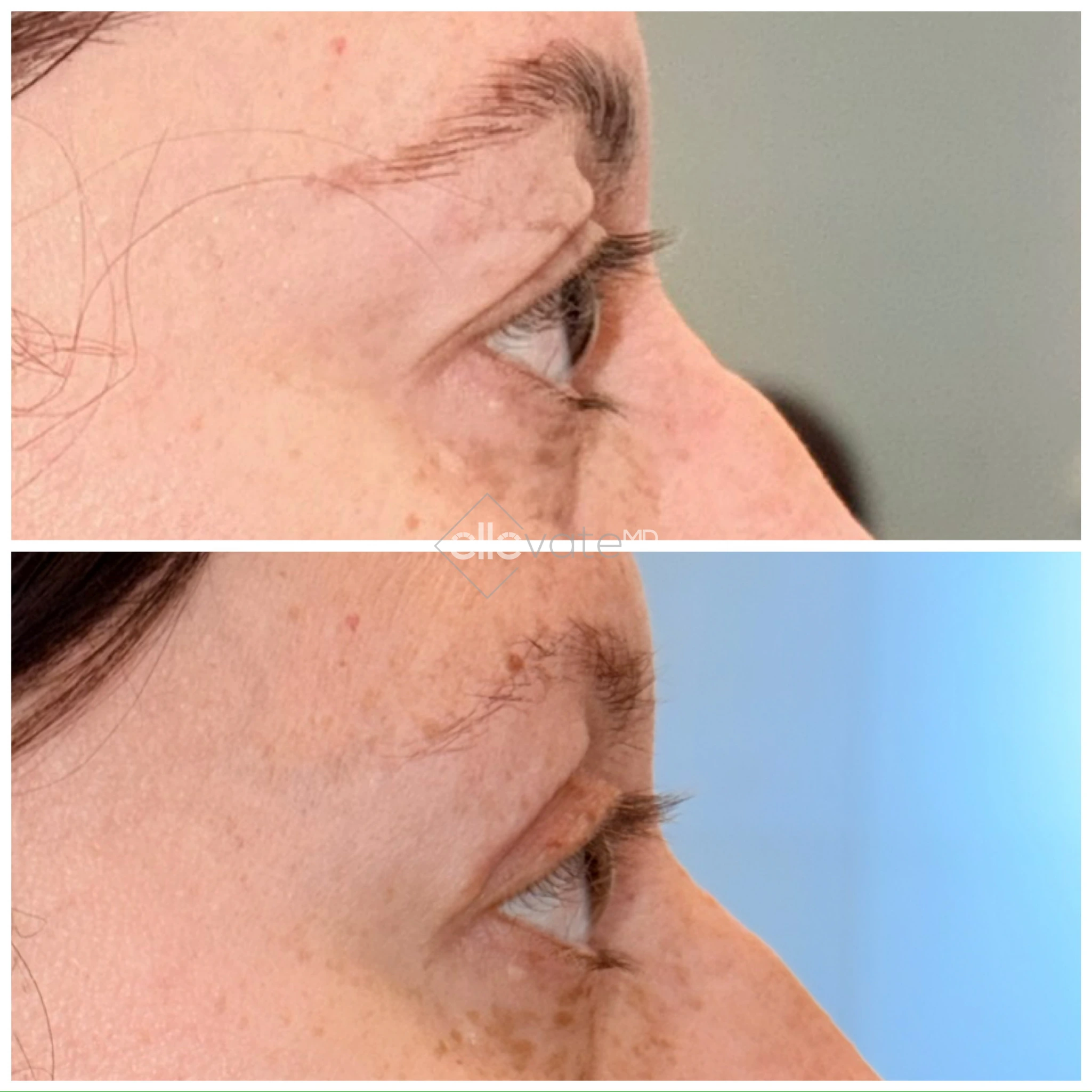 Before and after profile view of upper eyelid lift results
