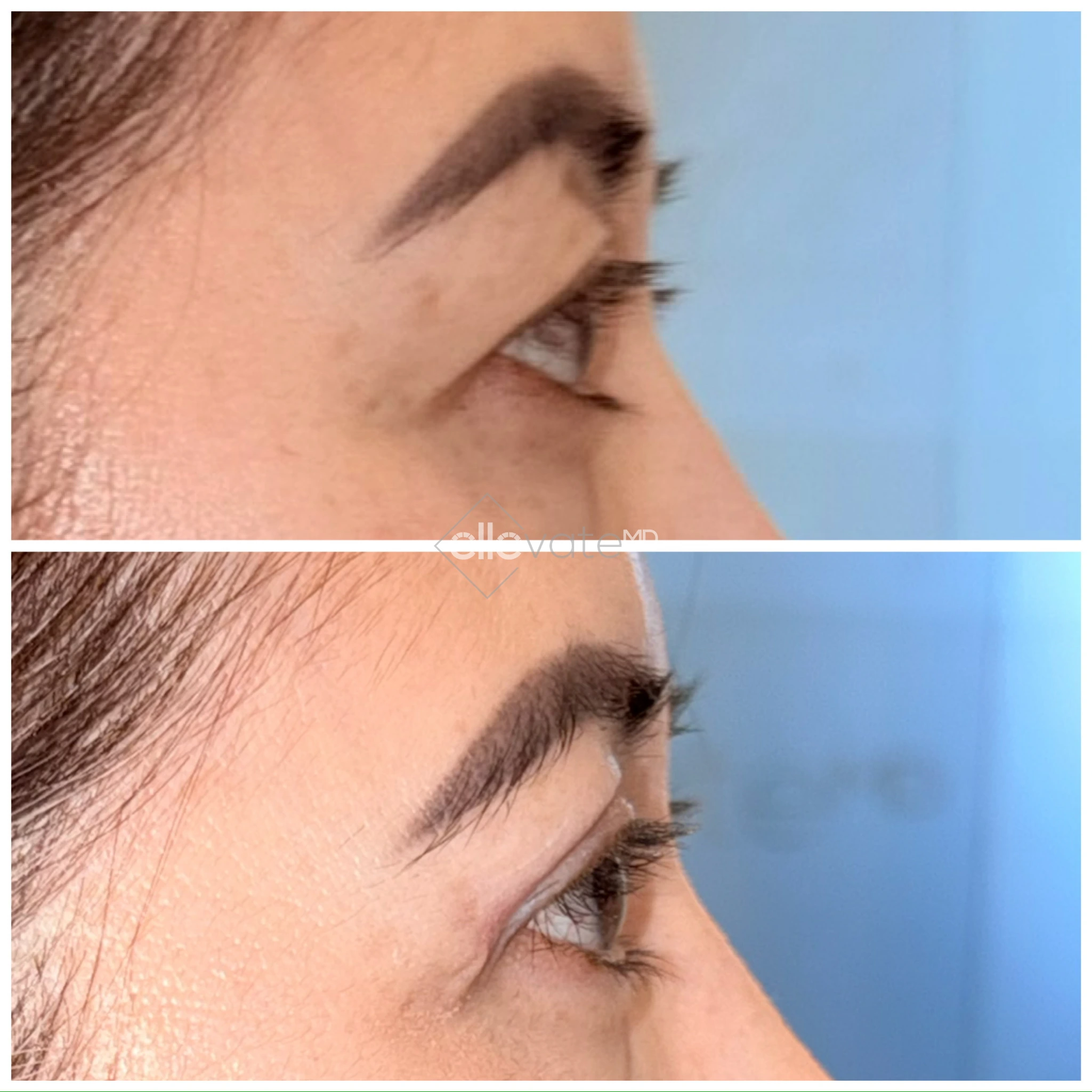 Before and after profile view of upper eyelid lift demonstrating lifted appearance