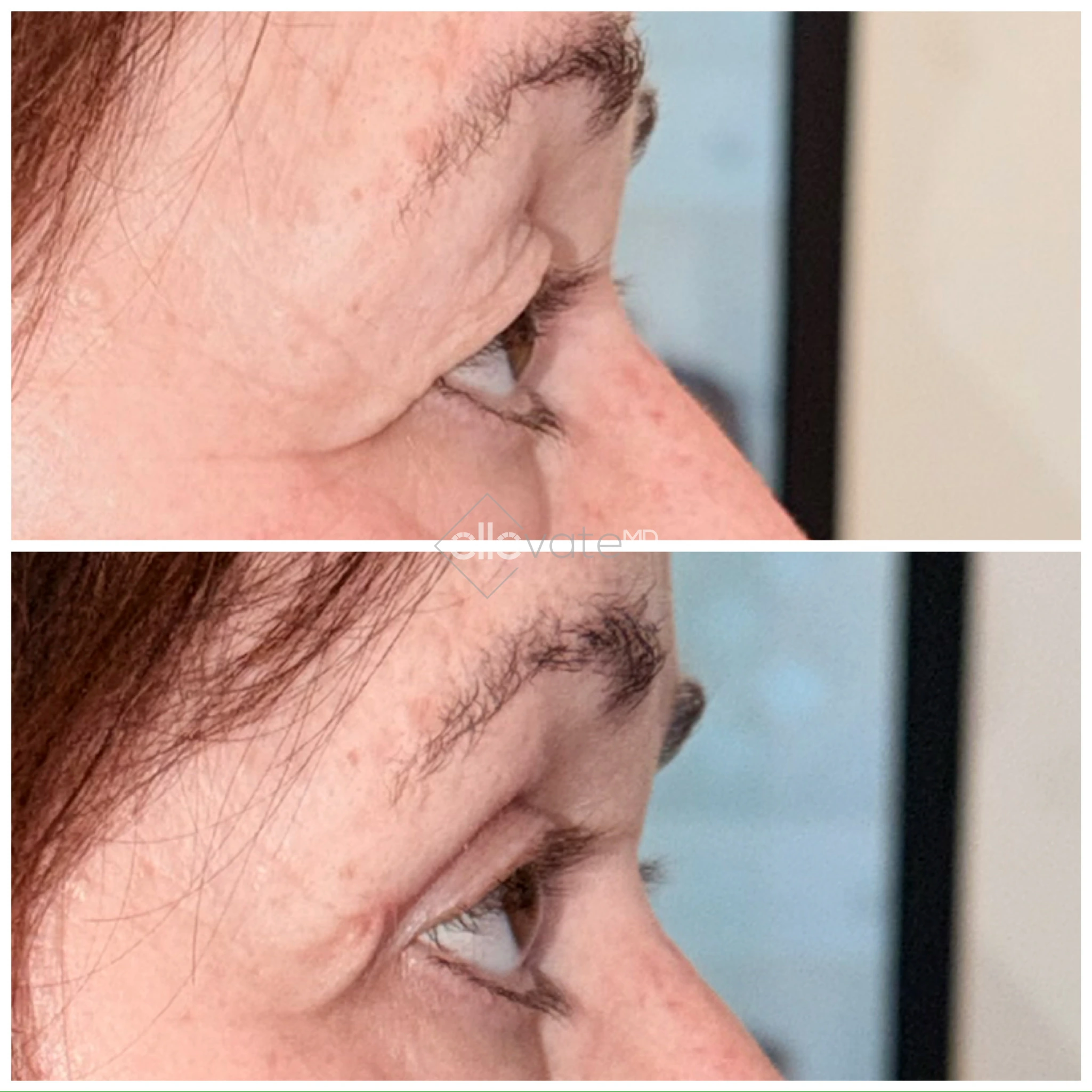 Before and after profile view of upper eyelid lift showing refined eyelid shape