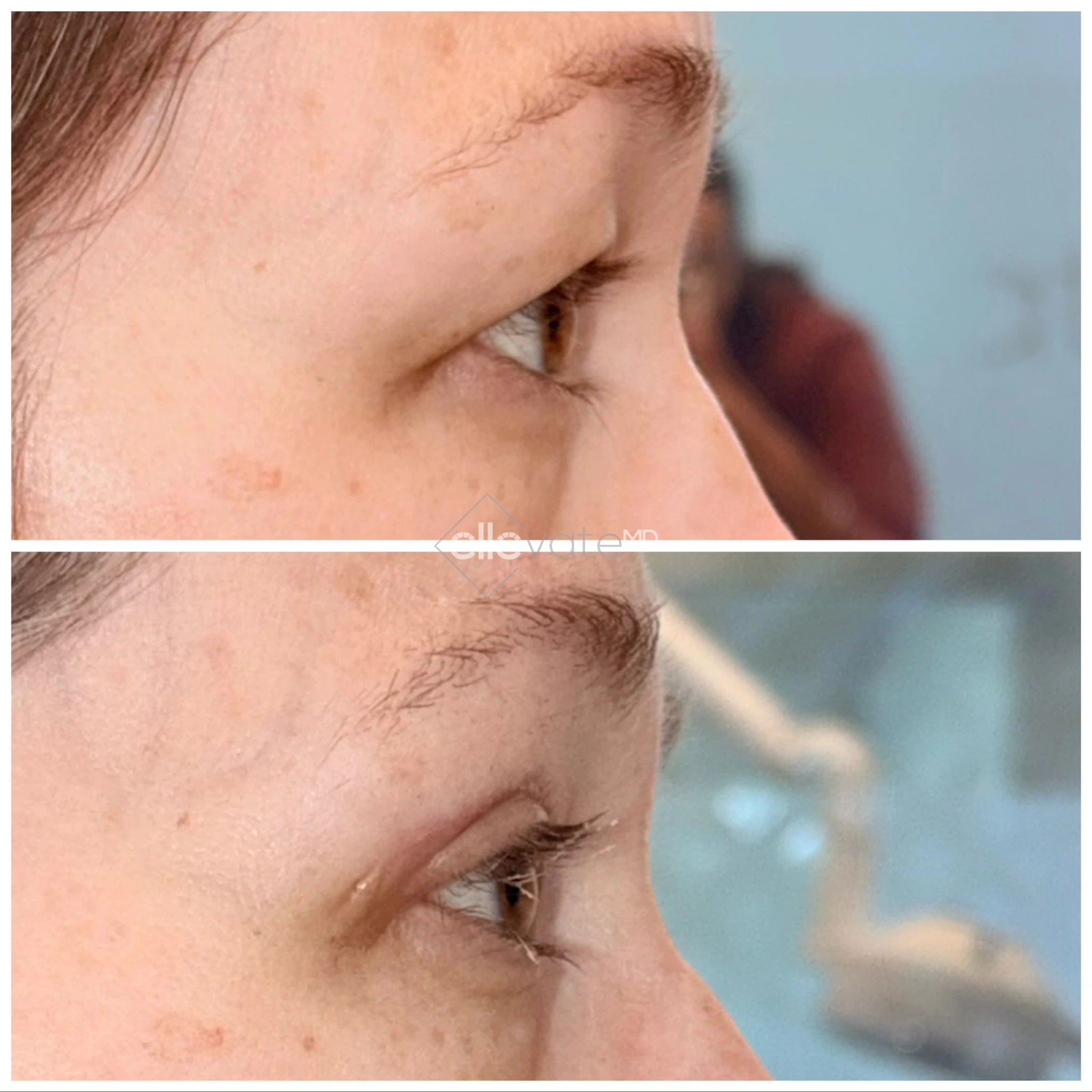 Before and after profile view of upper eyelid lift with improved eyelid elevation