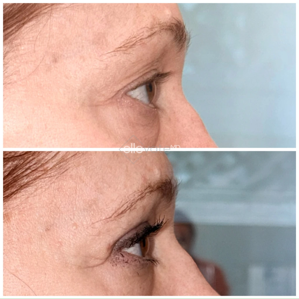 Before and after profile view of upper eyelid lift displaying enhanced eyelid definition