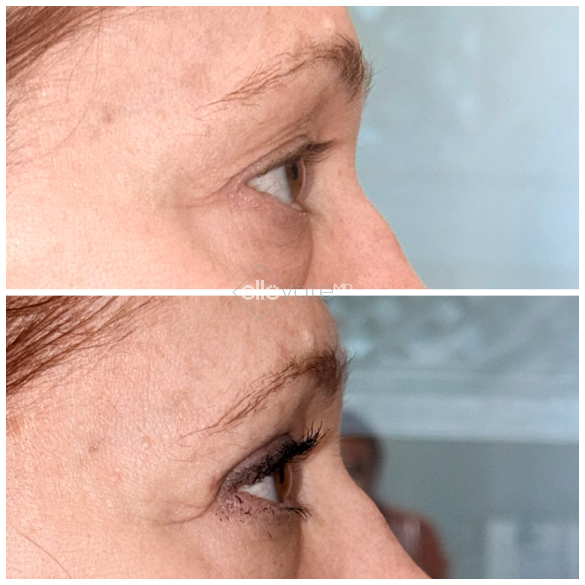 Before and after profile view of upper eyelid lift displaying enhanced eyelid definition