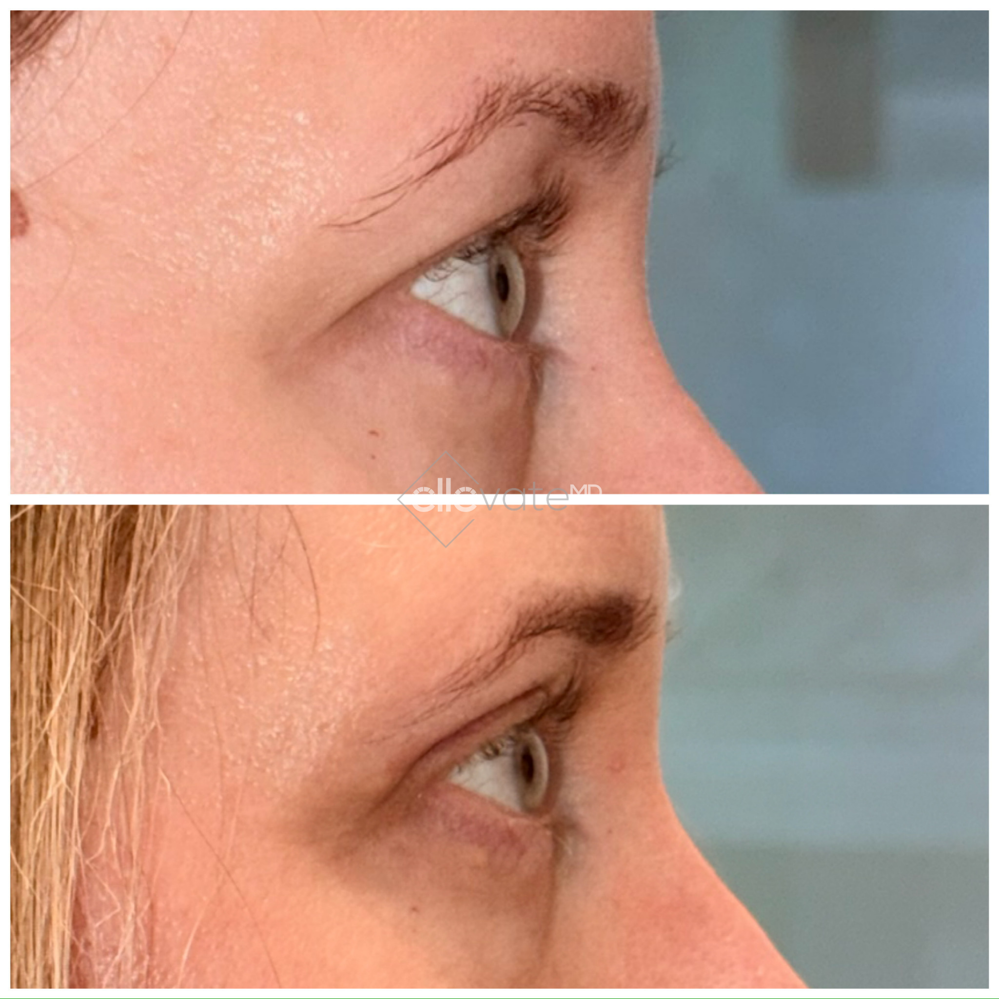 Before and after profile view of upper eyelid lift, showing improved eyelid elevation