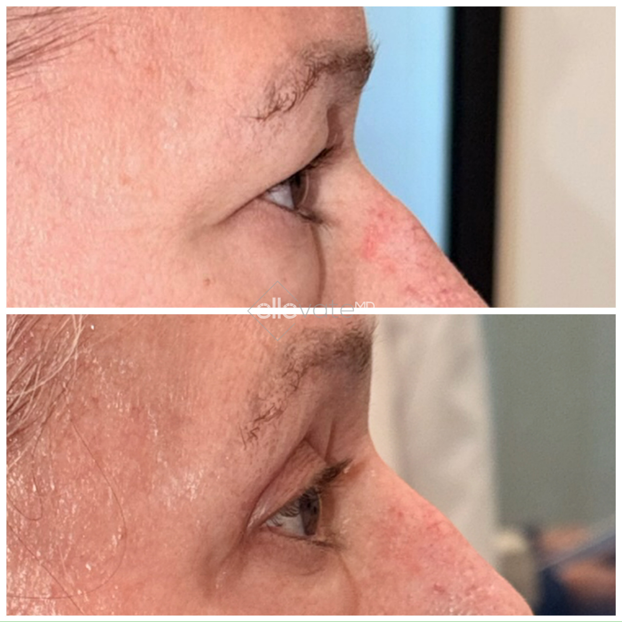 Before and after profile view of upper eyelid lift results