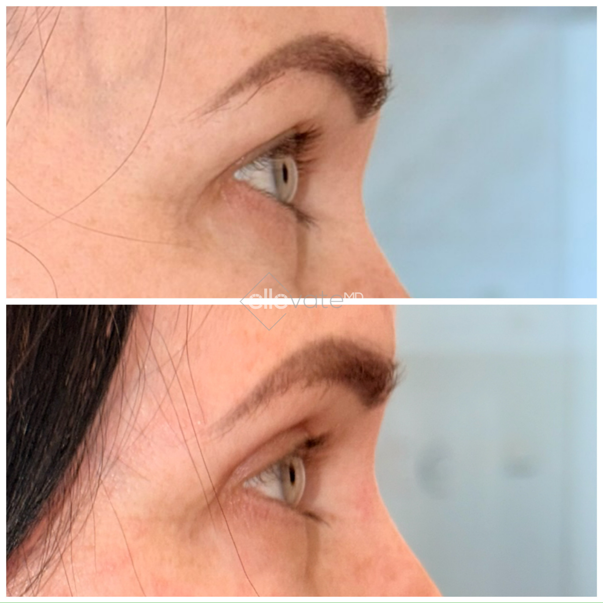 Before and after profile view of upper eyelid lift with lifted lid position