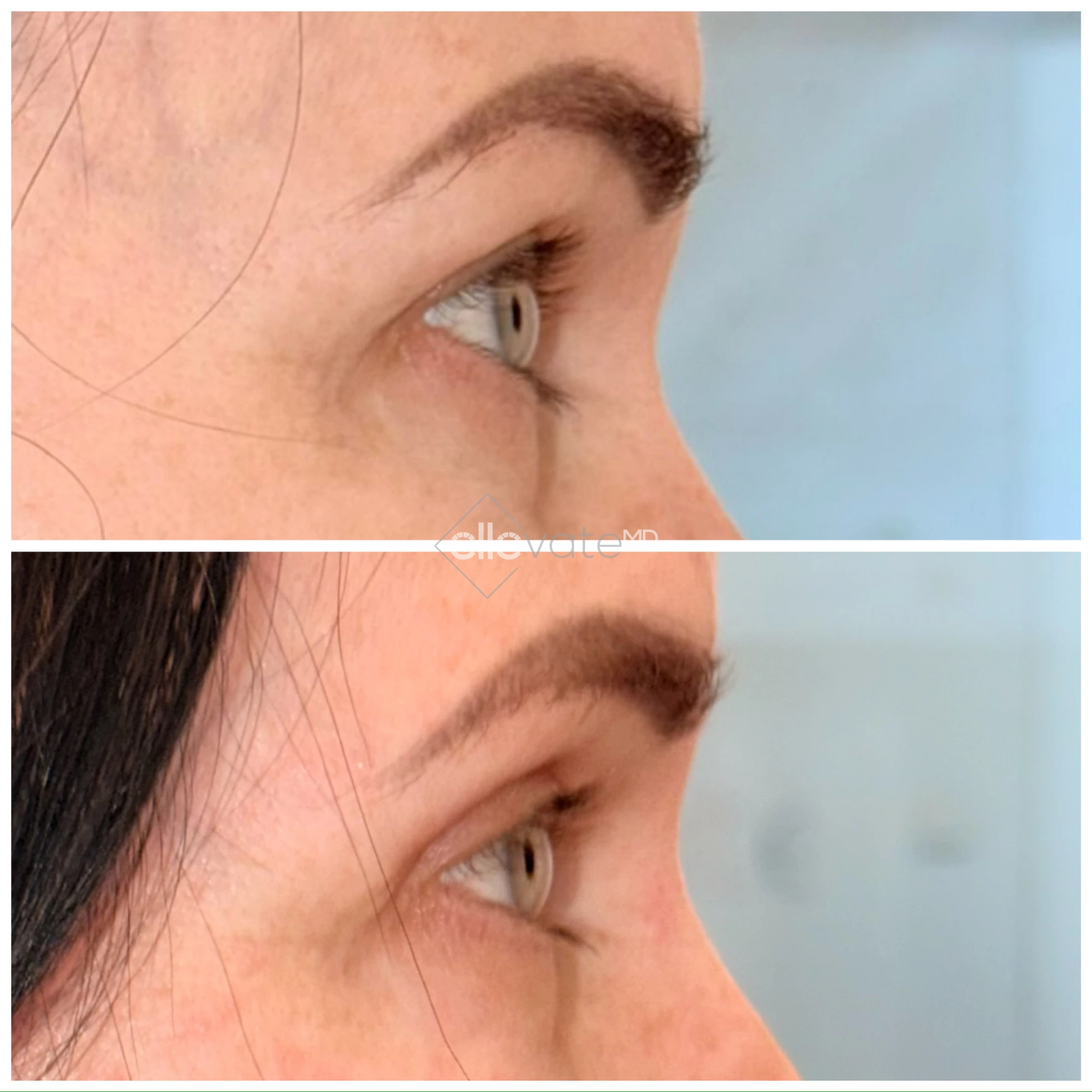 Before and after profile view of upper eyelid lift with lifted lid position
