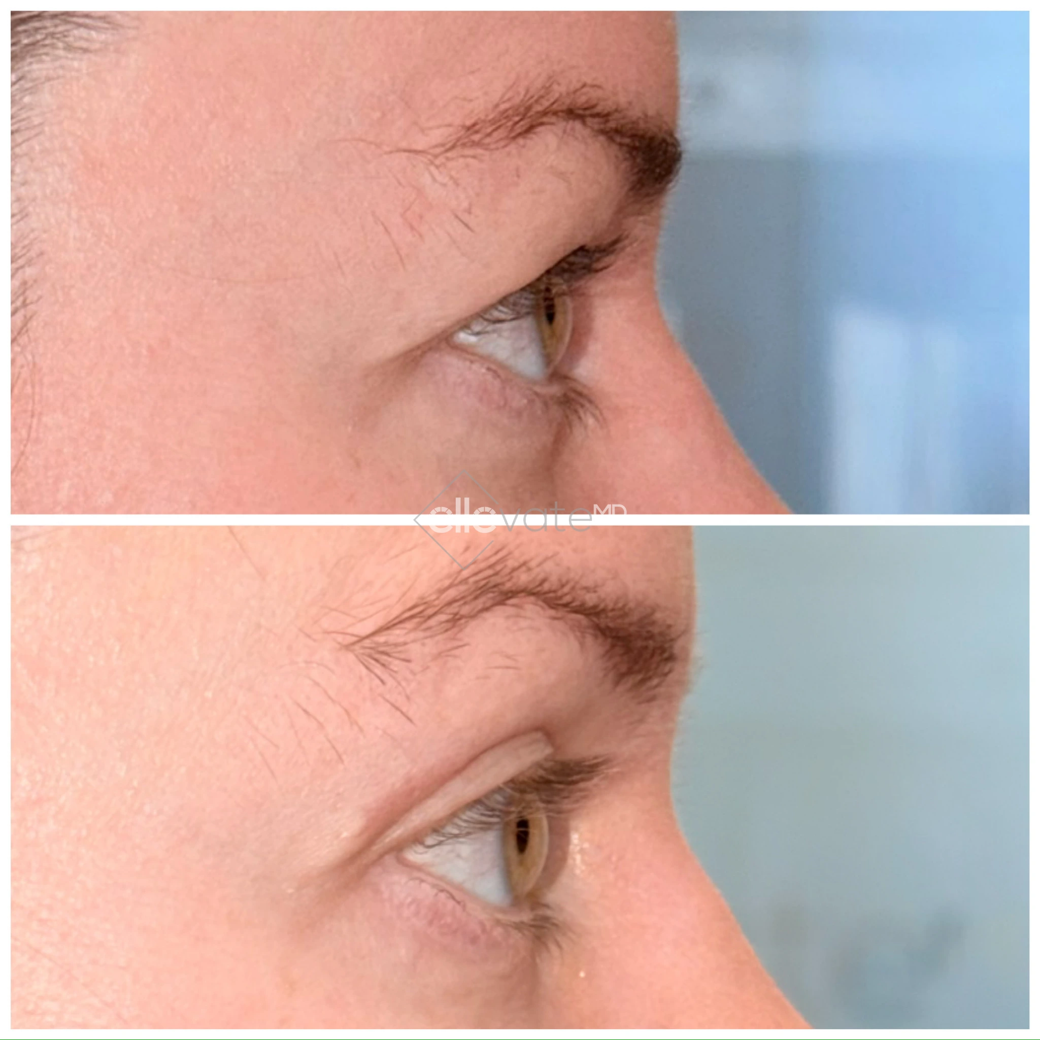 Before and after profile view of upper eyelid lift demonstrating eyelid elevation results
