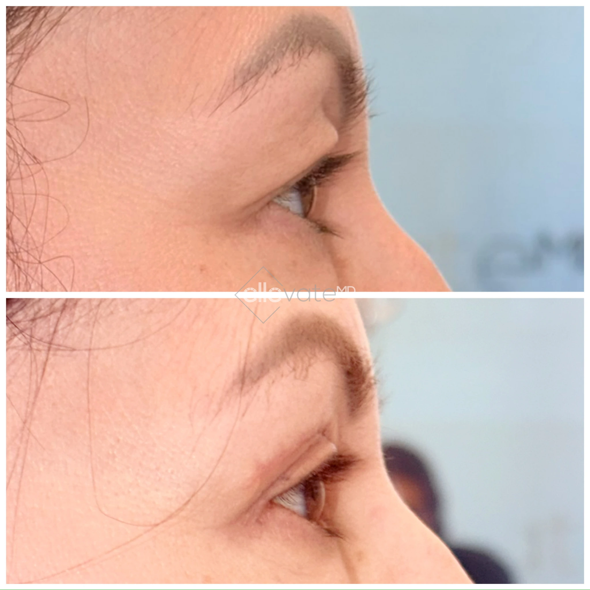 Before and after profile view of upper eyelid lift showing raised eyelid contour