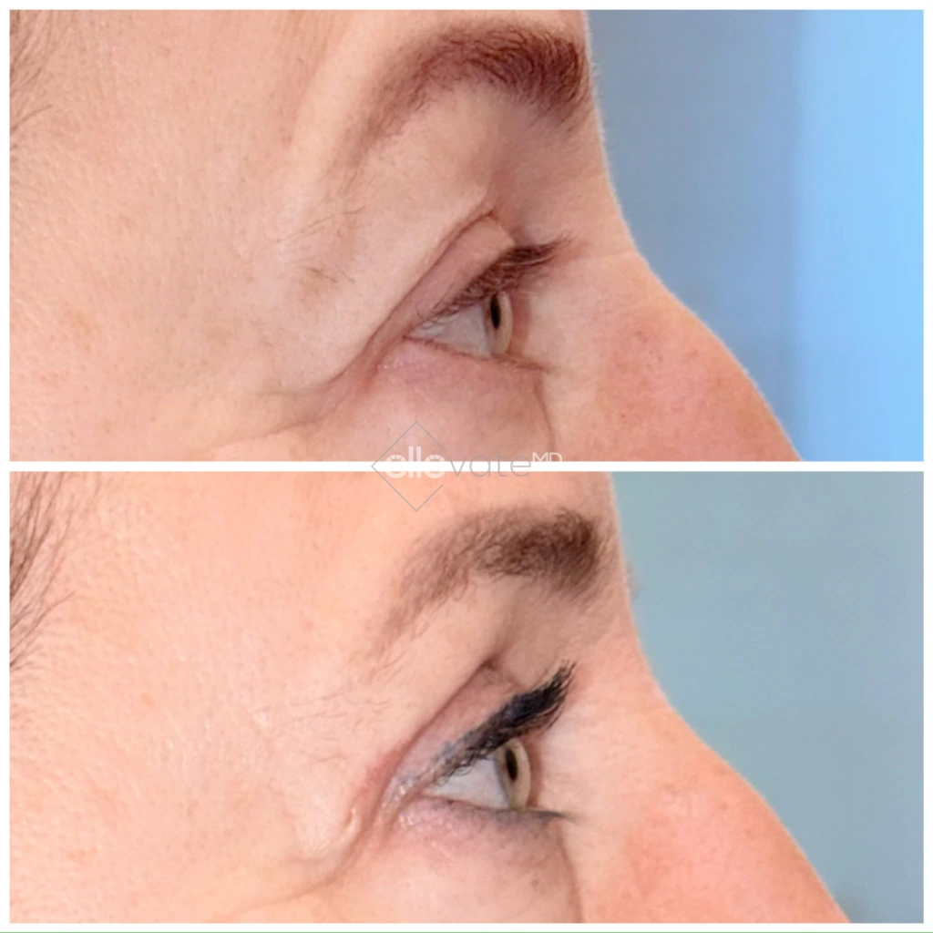 Before and after profile view of upper eyelid lift with enhanced eyelid opening