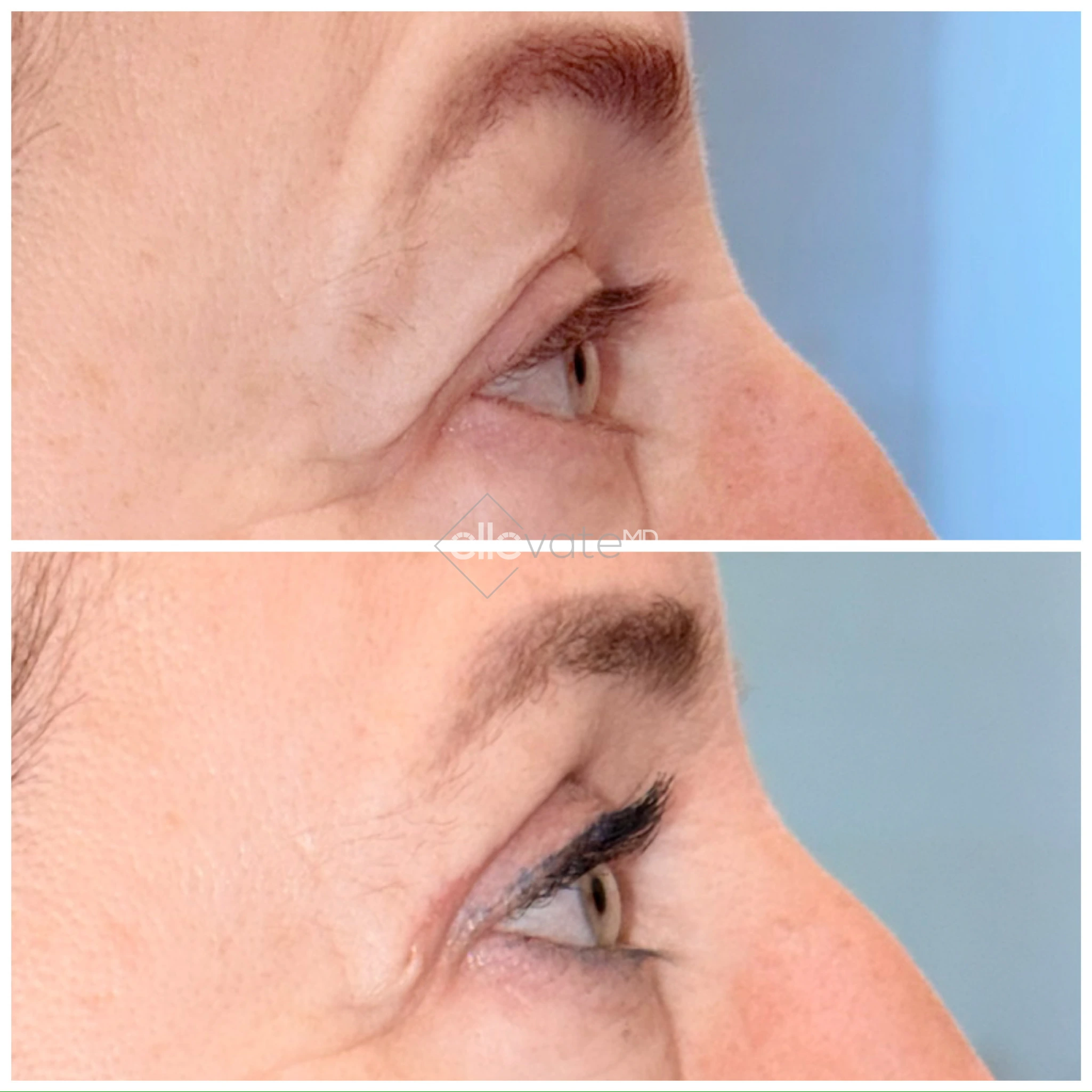 Before and after profile view of upper eyelid lift with enhanced eyelid opening