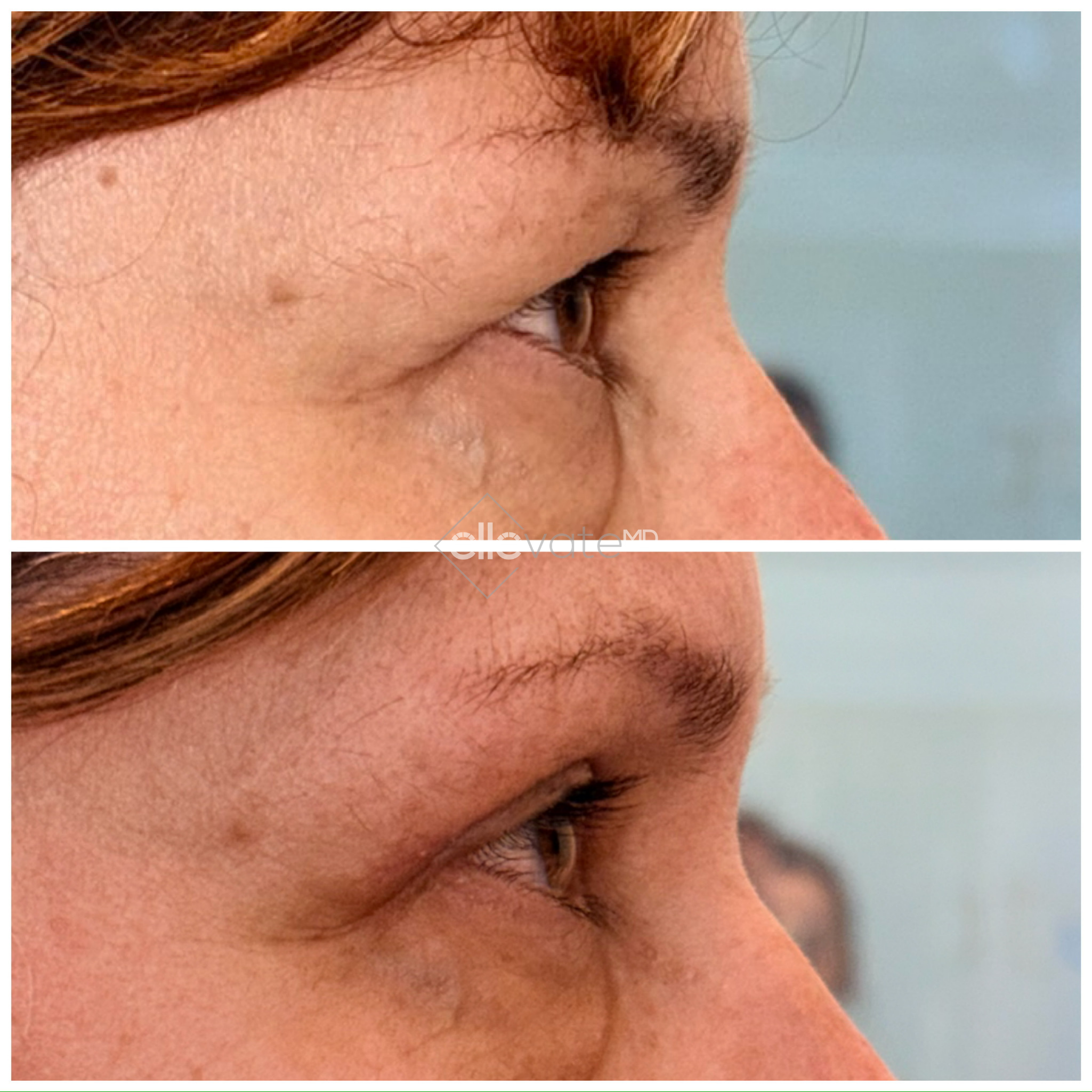 Before and after profile view of upper eyelid lift showing improved eyelid position and definition