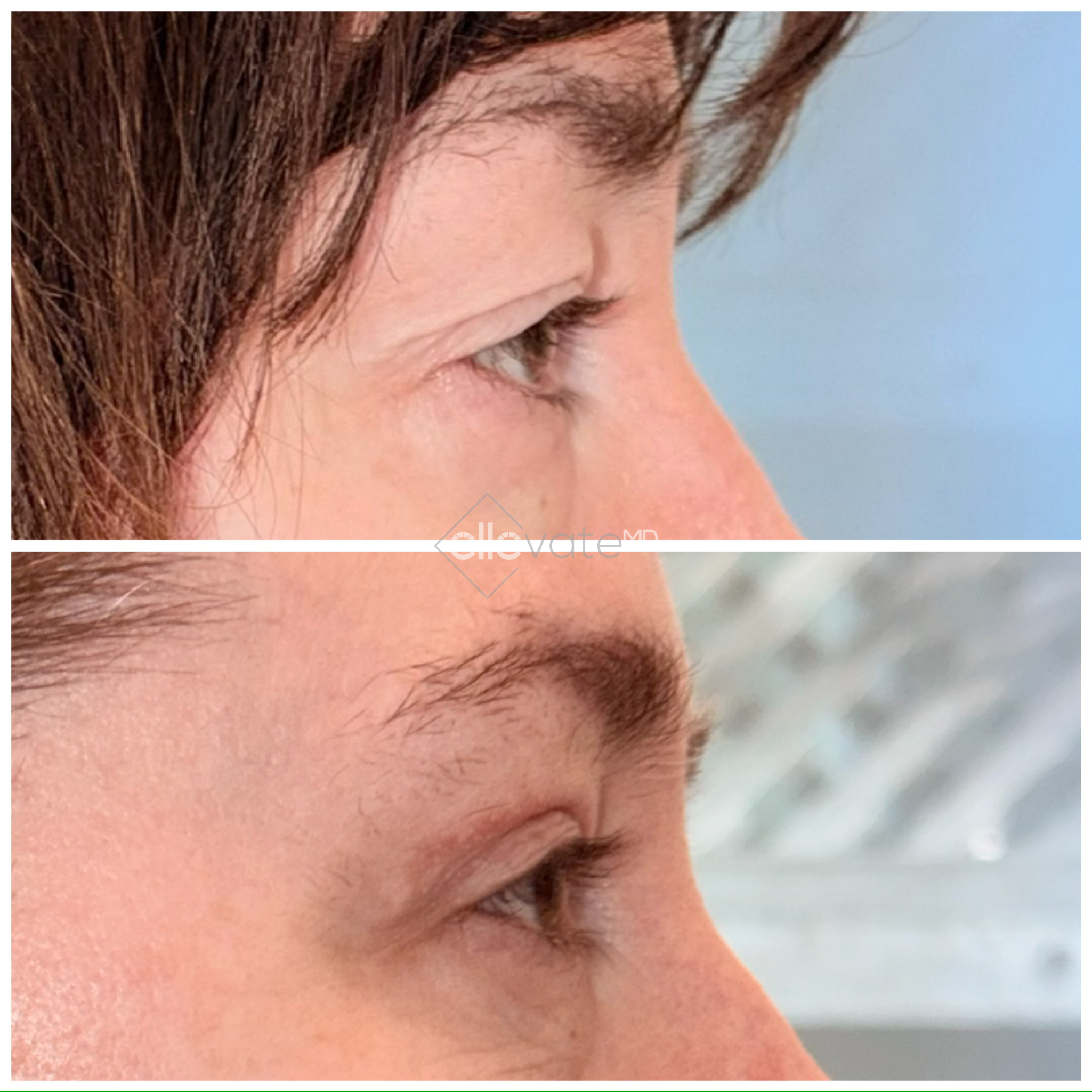 Before and after profile view of upper eyelid lift showing lifted eyelid contour