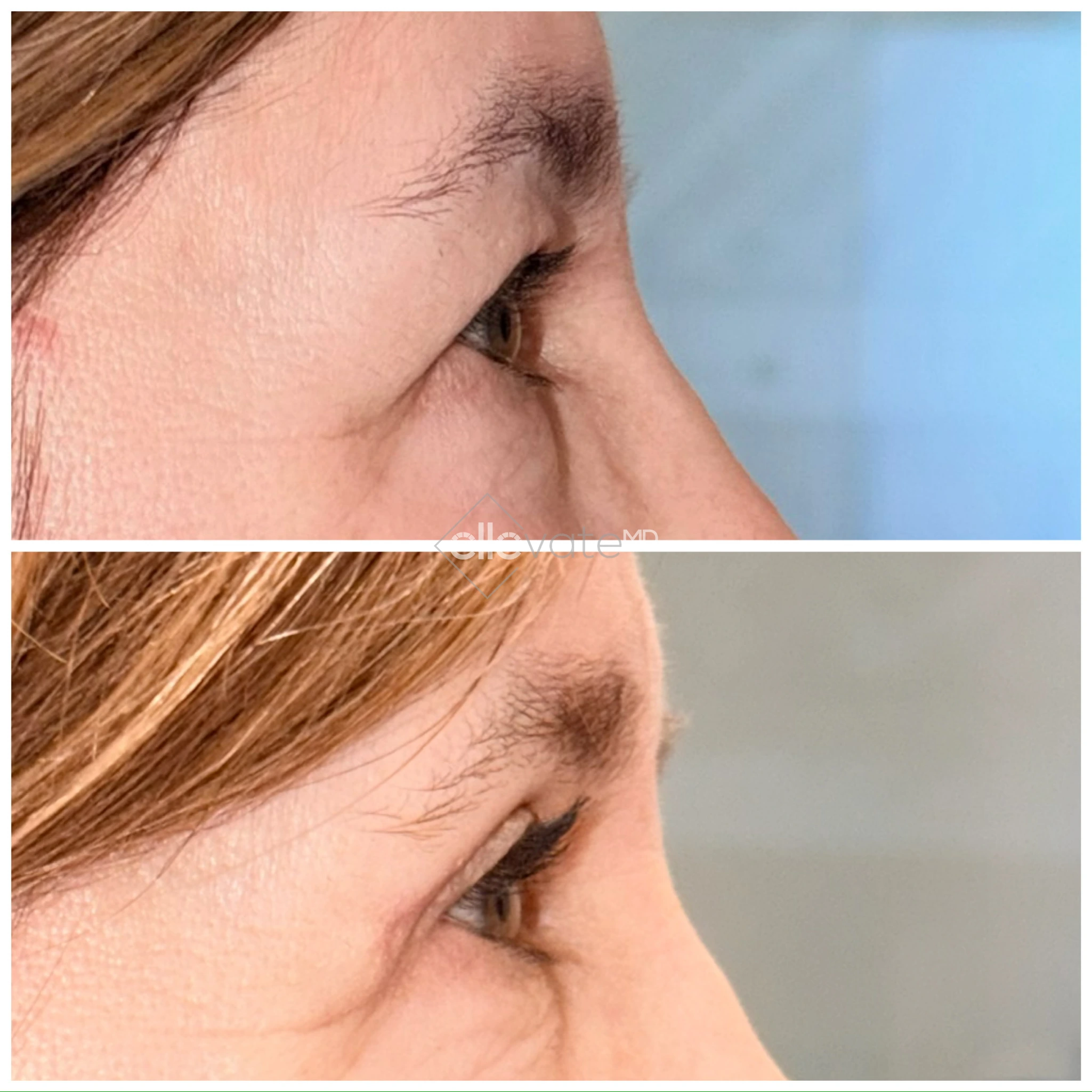 Before and after profile view of upper eyelid lift showing refined upper eyelid contour