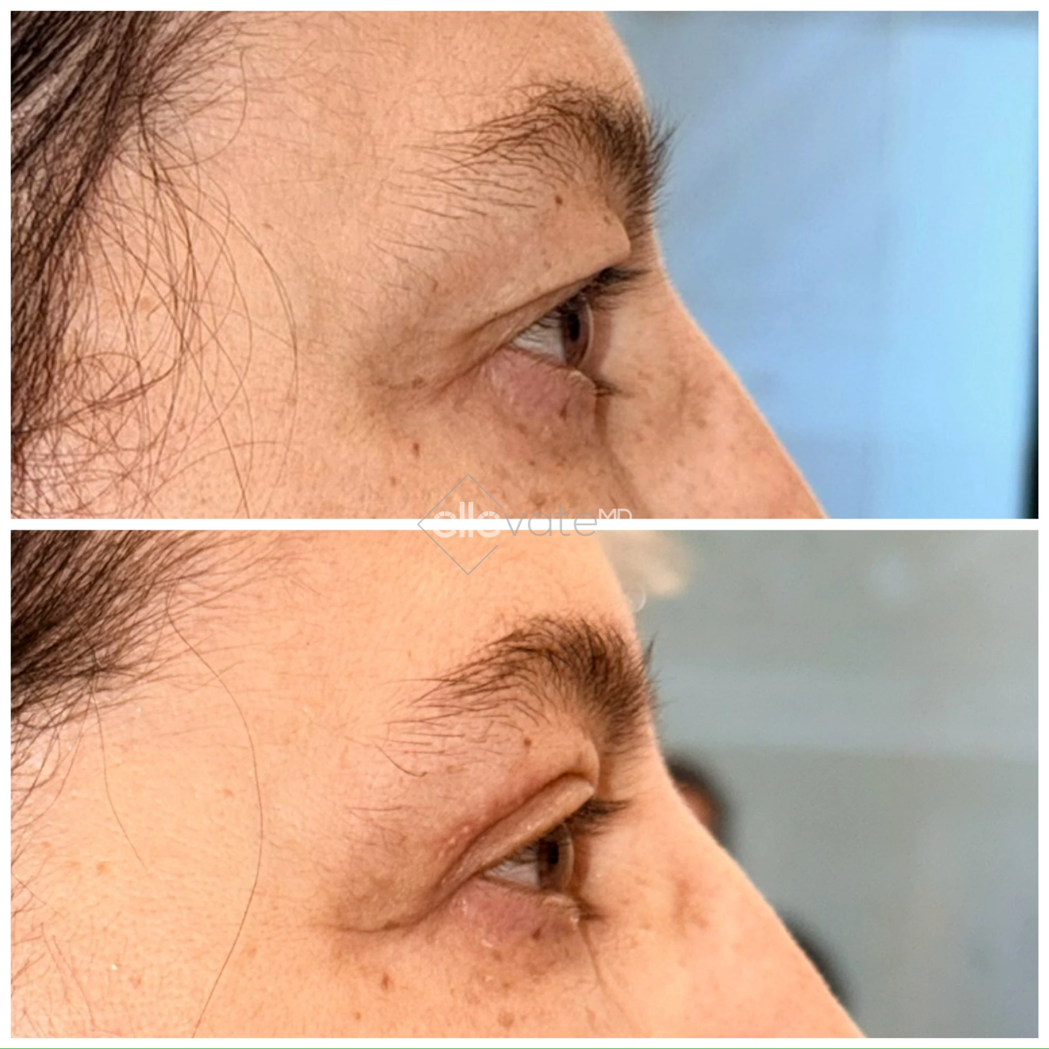 Before and after profile view of upper eyelid lift showing lifted and rejuvenated eyelid appearance