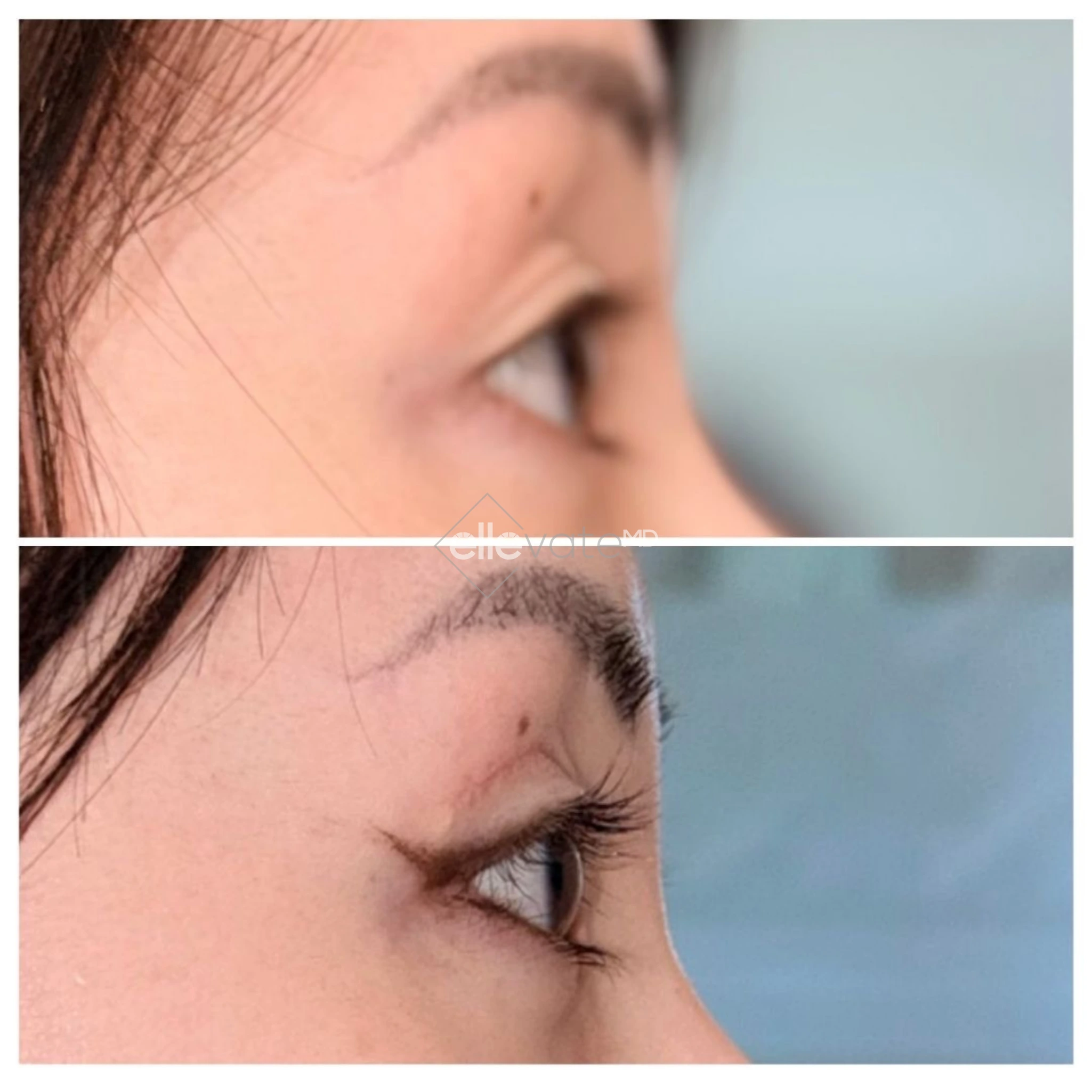 Before and after profile view of upper eyelid lift showing improved eyelid elevation and contour