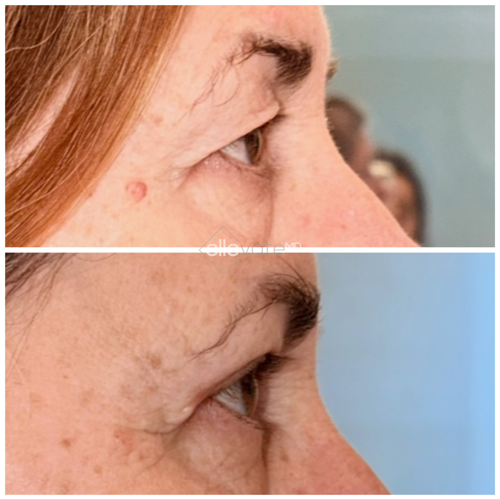 Before and after profile view of upper eyelid lift results