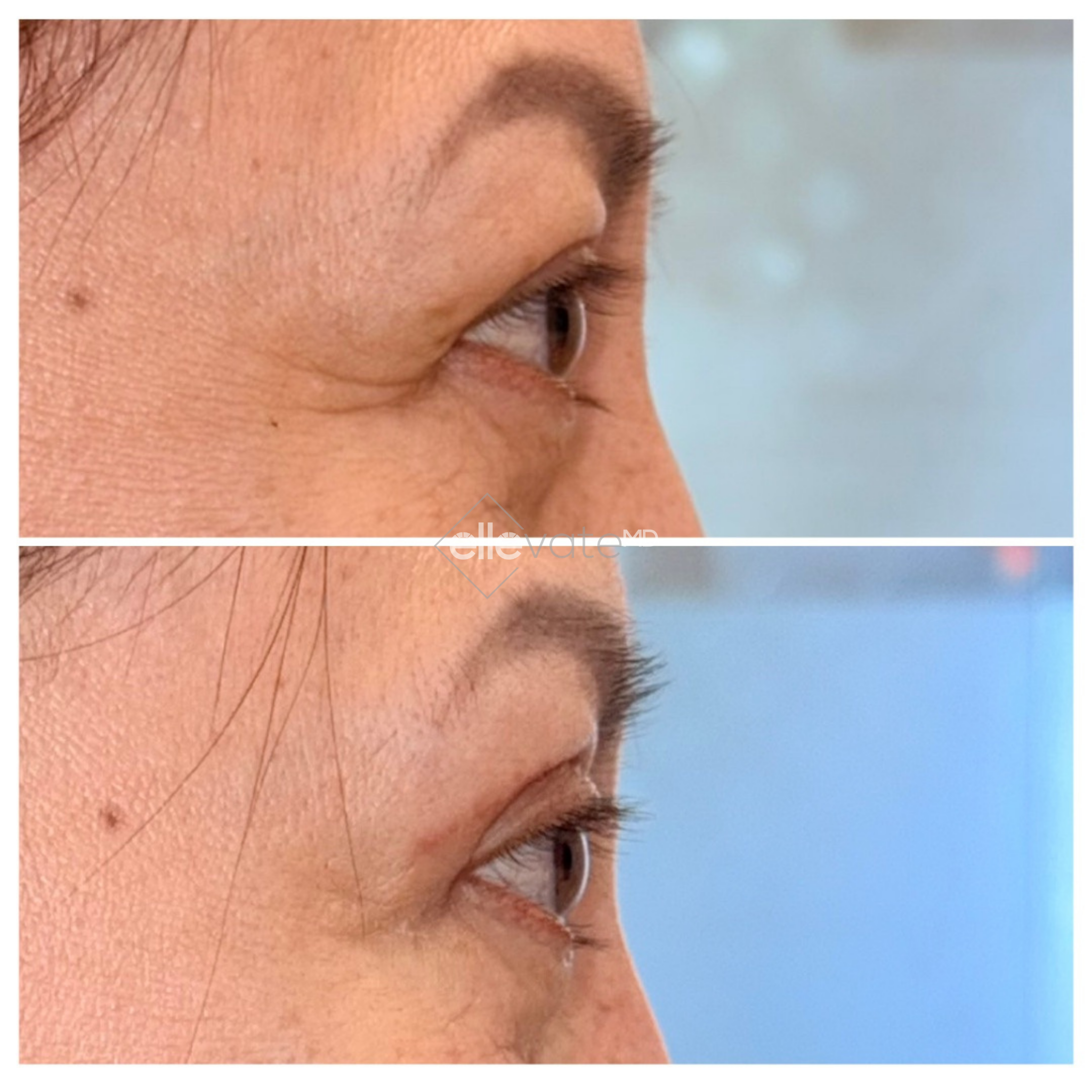 Before and after profile view of upper eyelid lift results