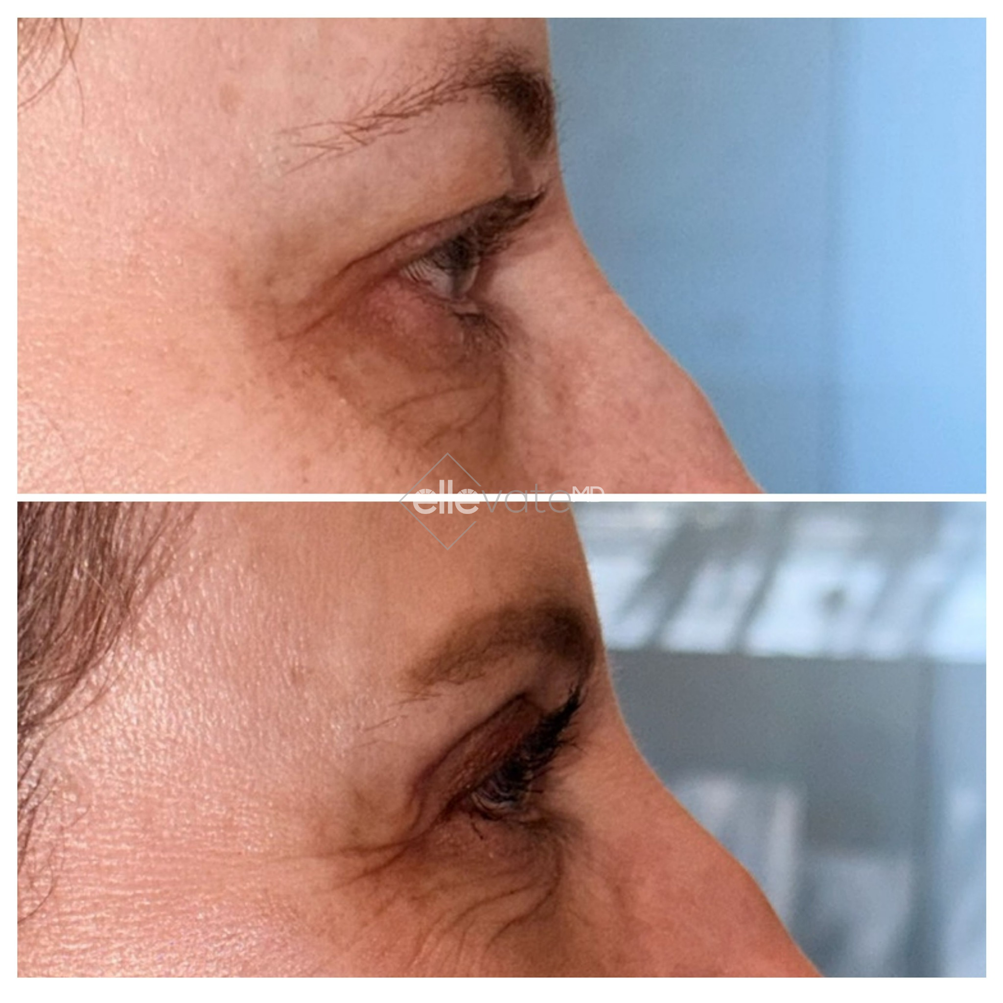 Before and after profile view of upper eyelid lift demonstrating reduced drooping and refreshed eye appearance
