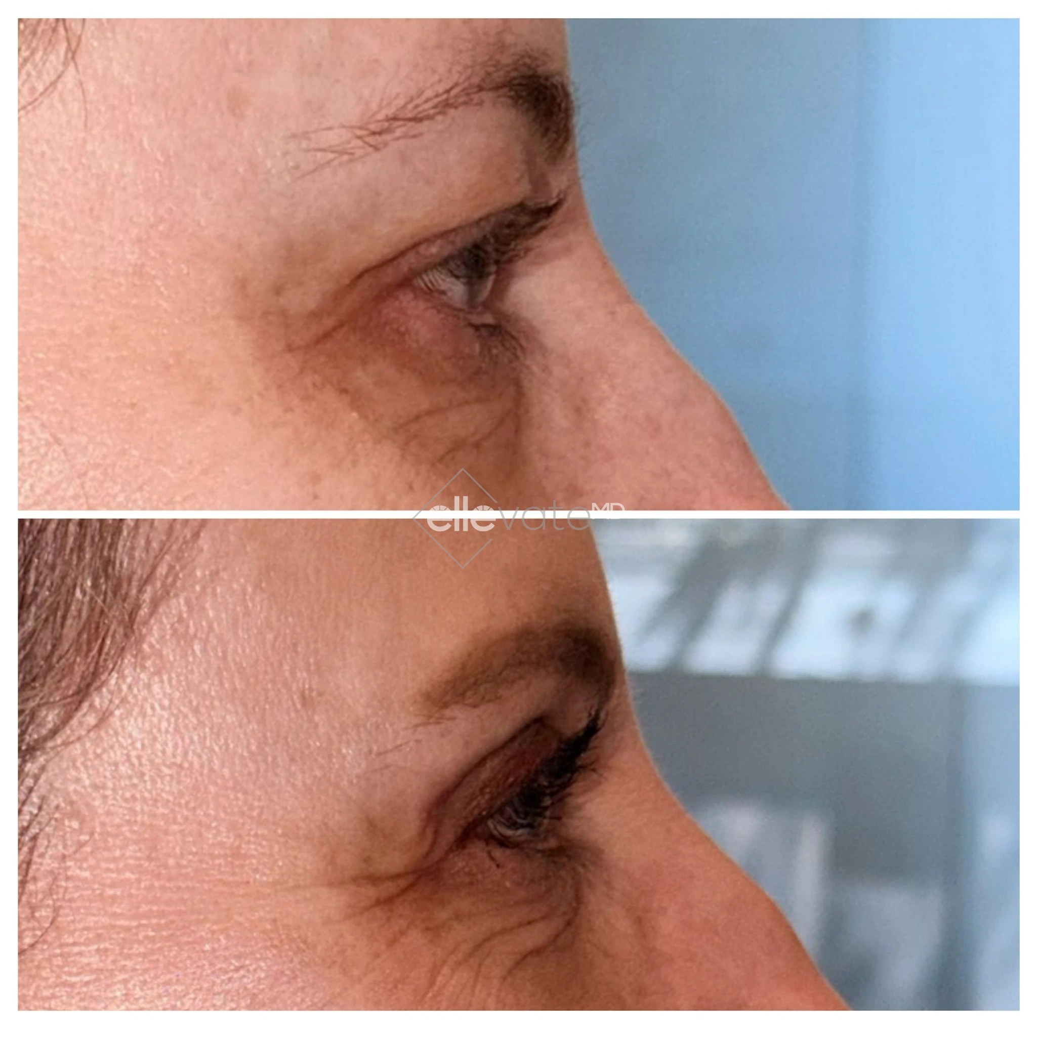 Before and after profile view of upper eyelid lift demonstrating reduced drooping and refreshed eye appearance