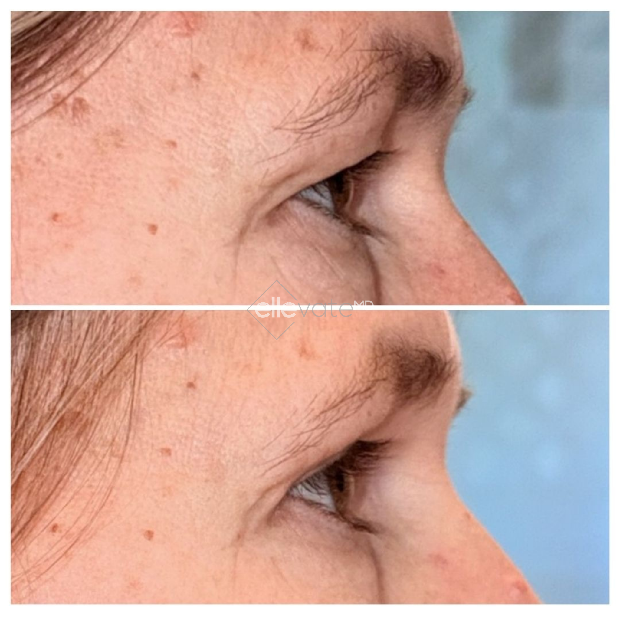 Before and after profile view of upper eyelid lift showing lifted lid position and enhanced eye opening
