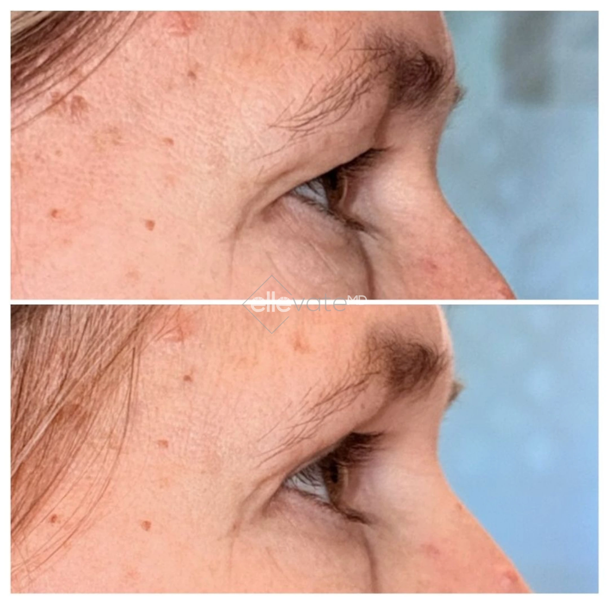 Before and after profile view of upper eyelid lift showing lifted lid position and enhanced eye opening