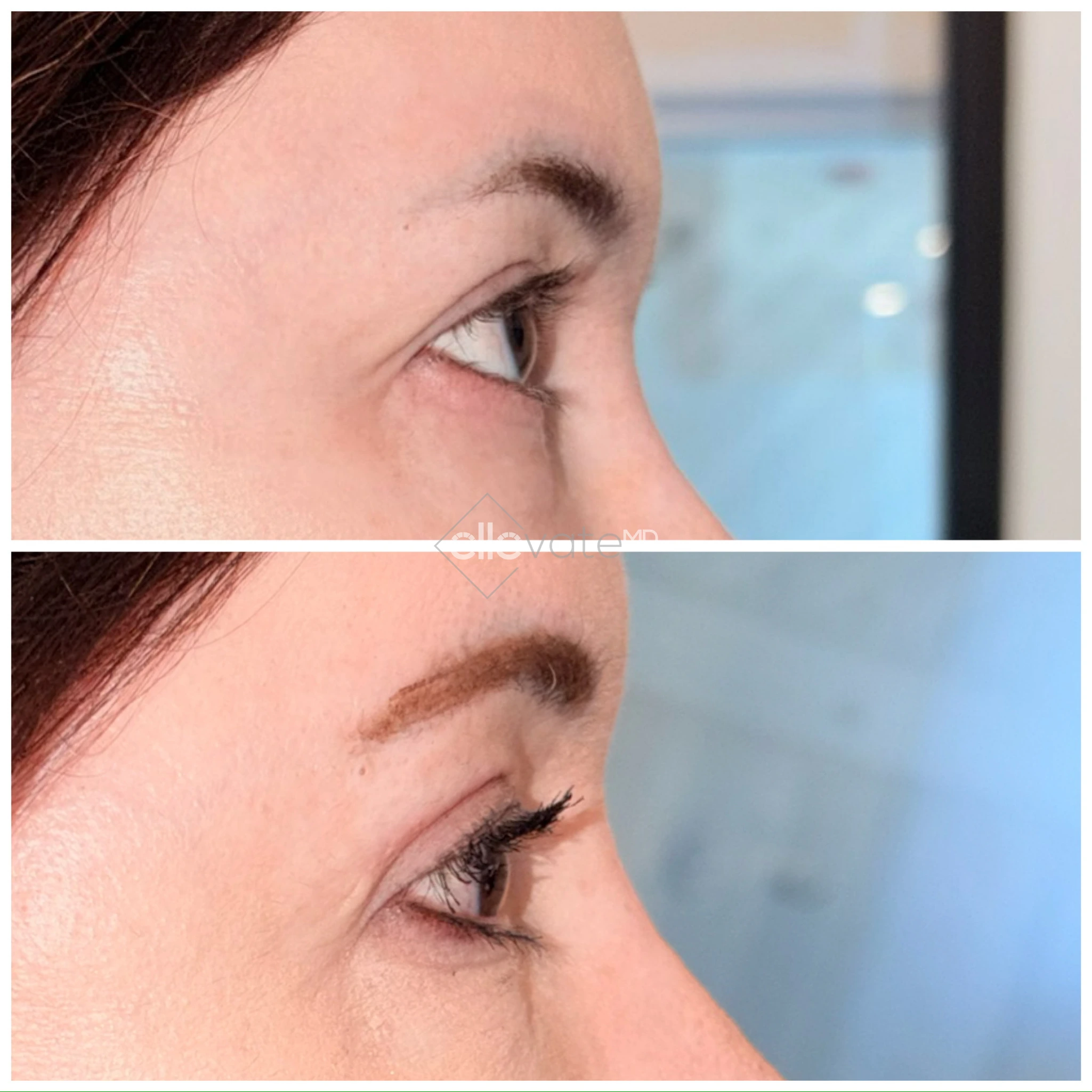 Before and after profile view of upper eyelid lift displaying improved upper lid definition and elevation