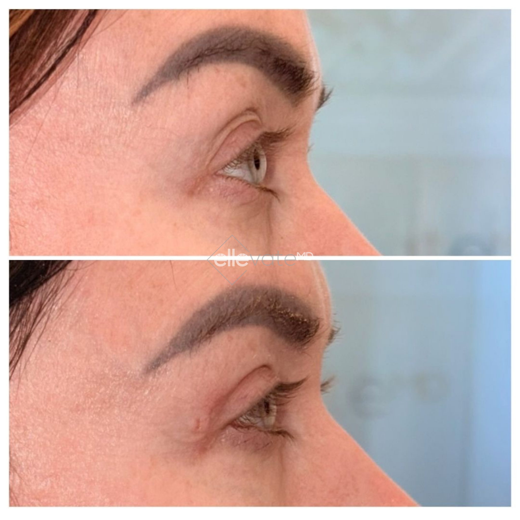 Before and after profile view of upper eyelid lift showing corrected ptosis and restored eyelid height