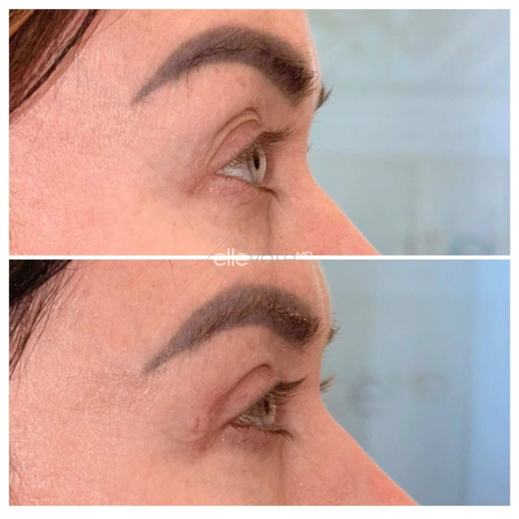 Before and after profile view of upper eyelid lift showing corrected ptosis and restored eyelid height