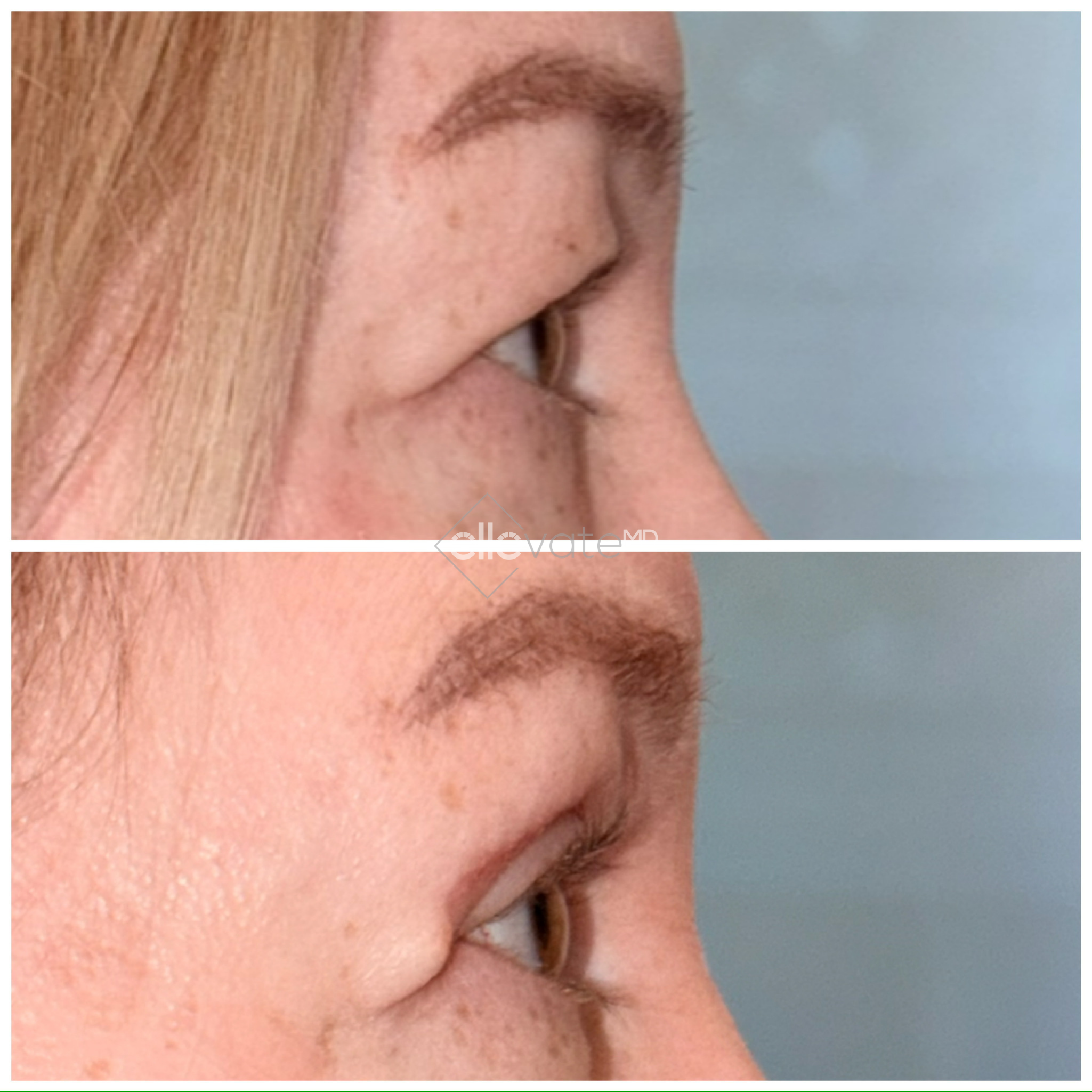 Before and after profile view of upper eyelid lift results