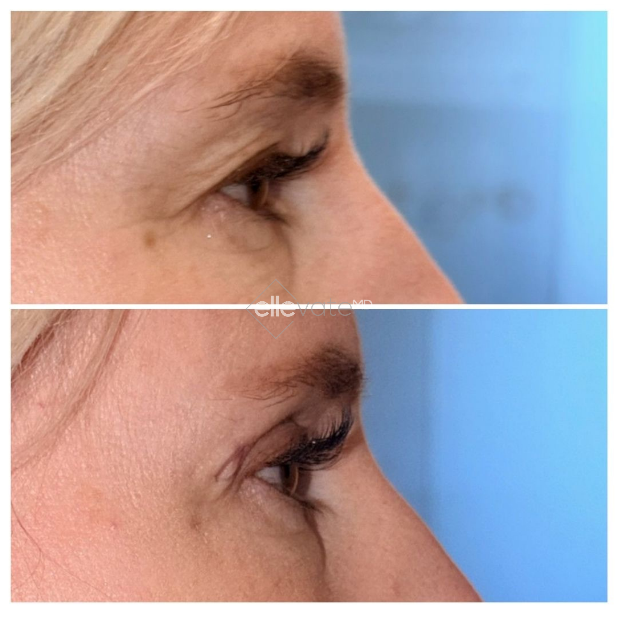 Before and after profile view of upper eyelid lift showing improved eyelid contour