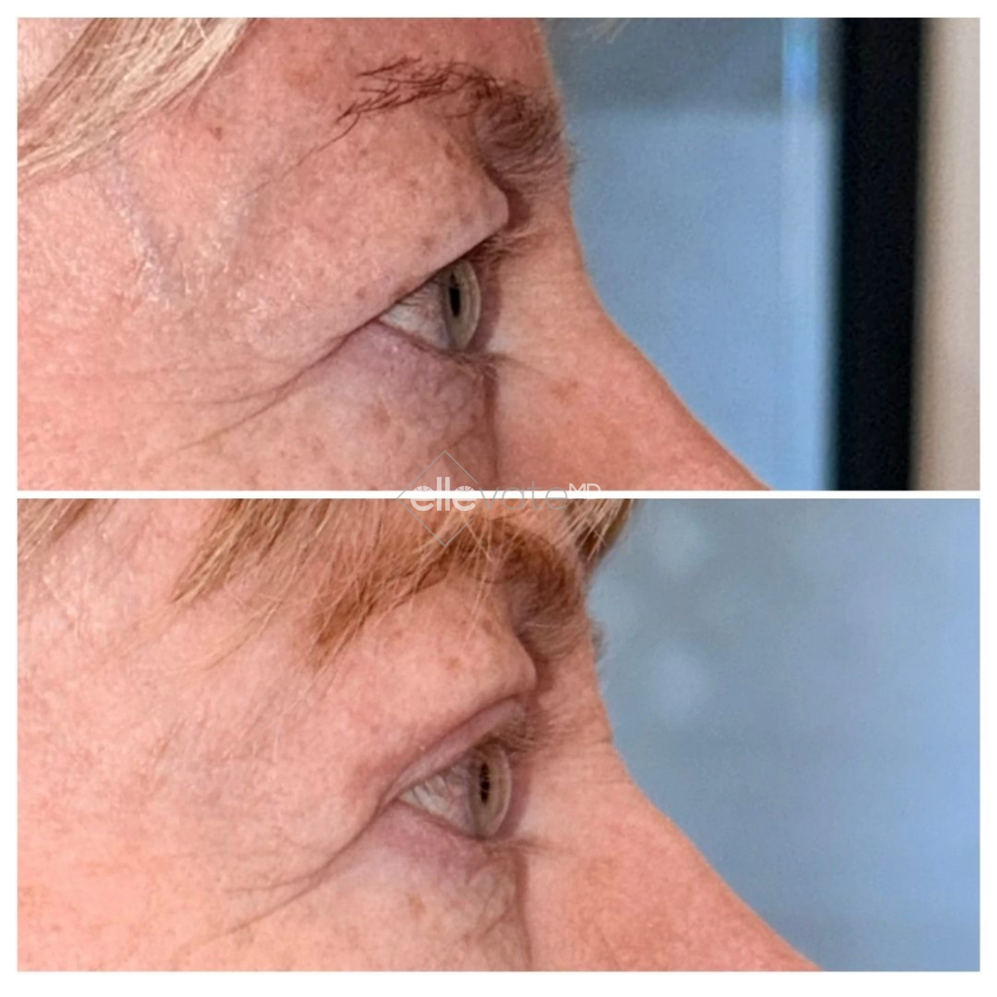 Before and after profile view of upper eyelid lift demonstrating improved lid position and youthful eye contour