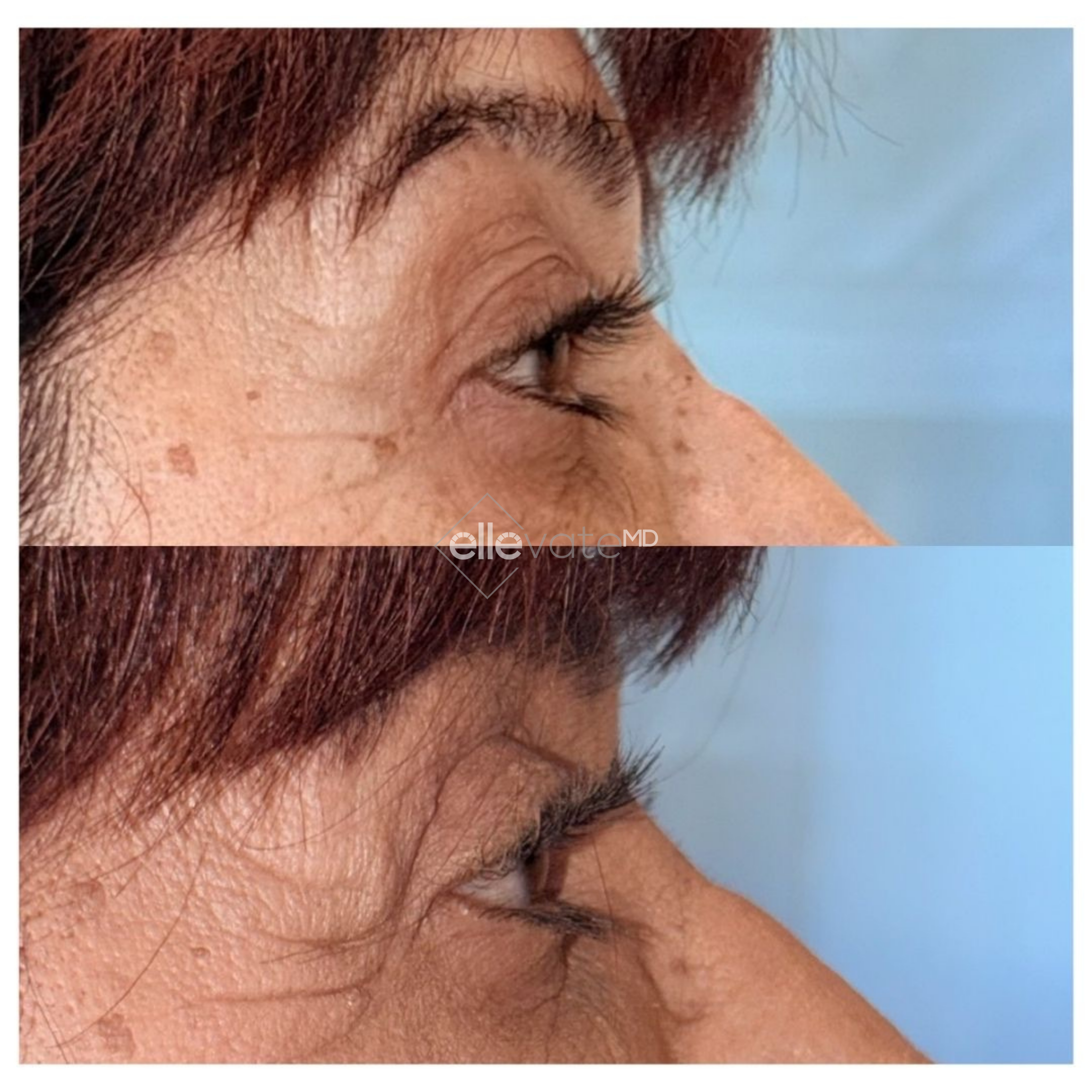 Before and after profile view of upper eyelid lift showing improved eyelid contour