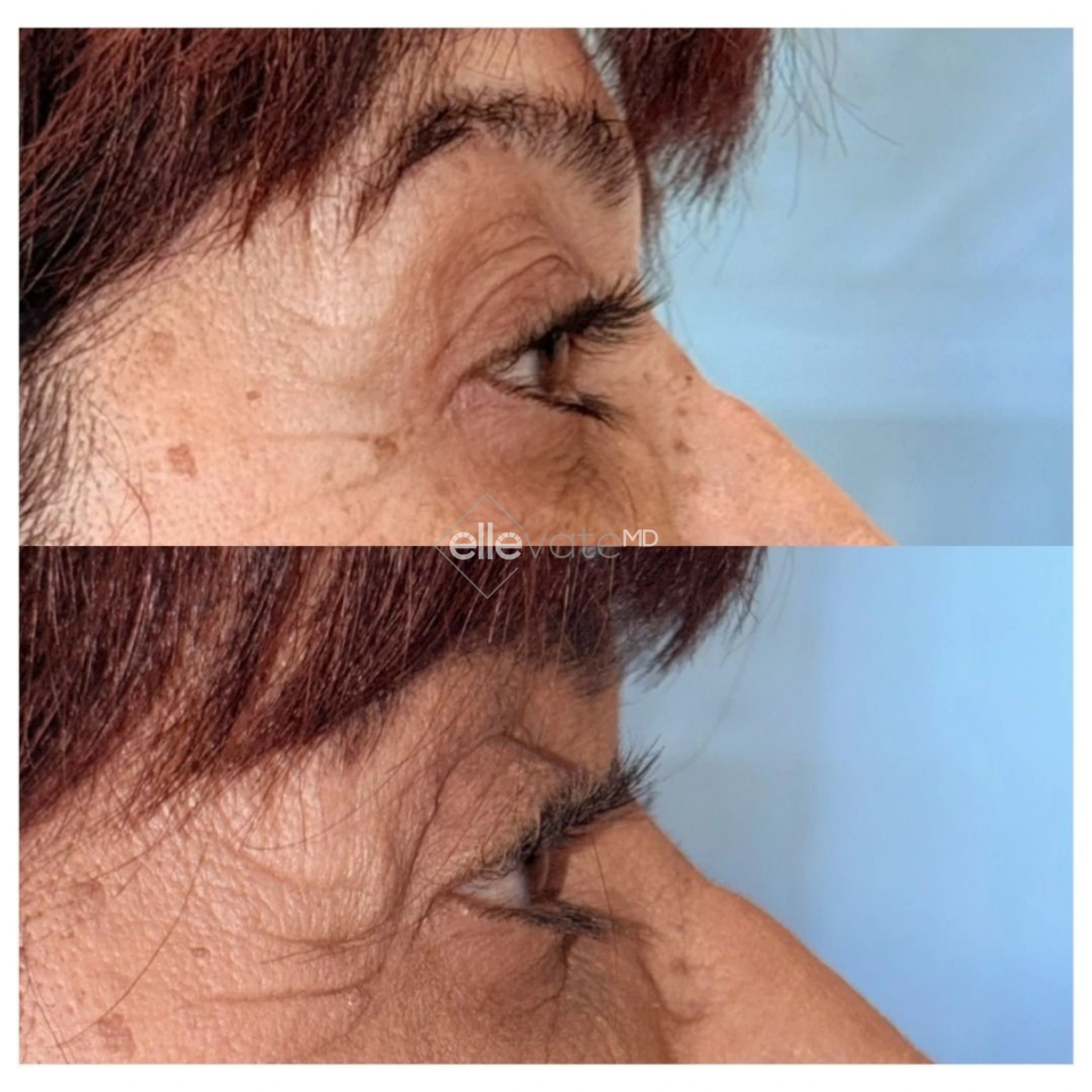 Before and after profile view of upper eyelid lift showing improved eyelid contour