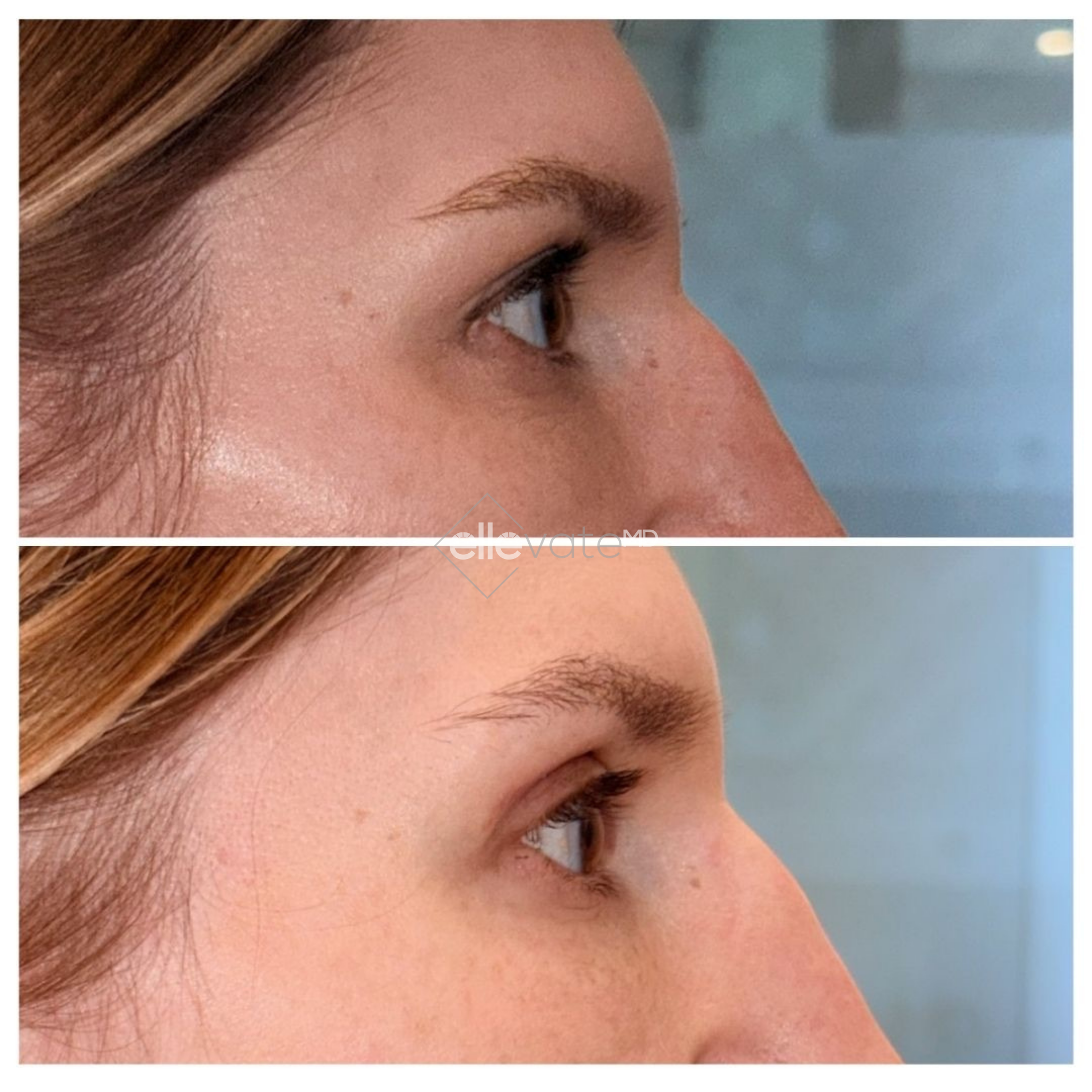 Before and after profile view of upper eyelid lift with elevated lid position