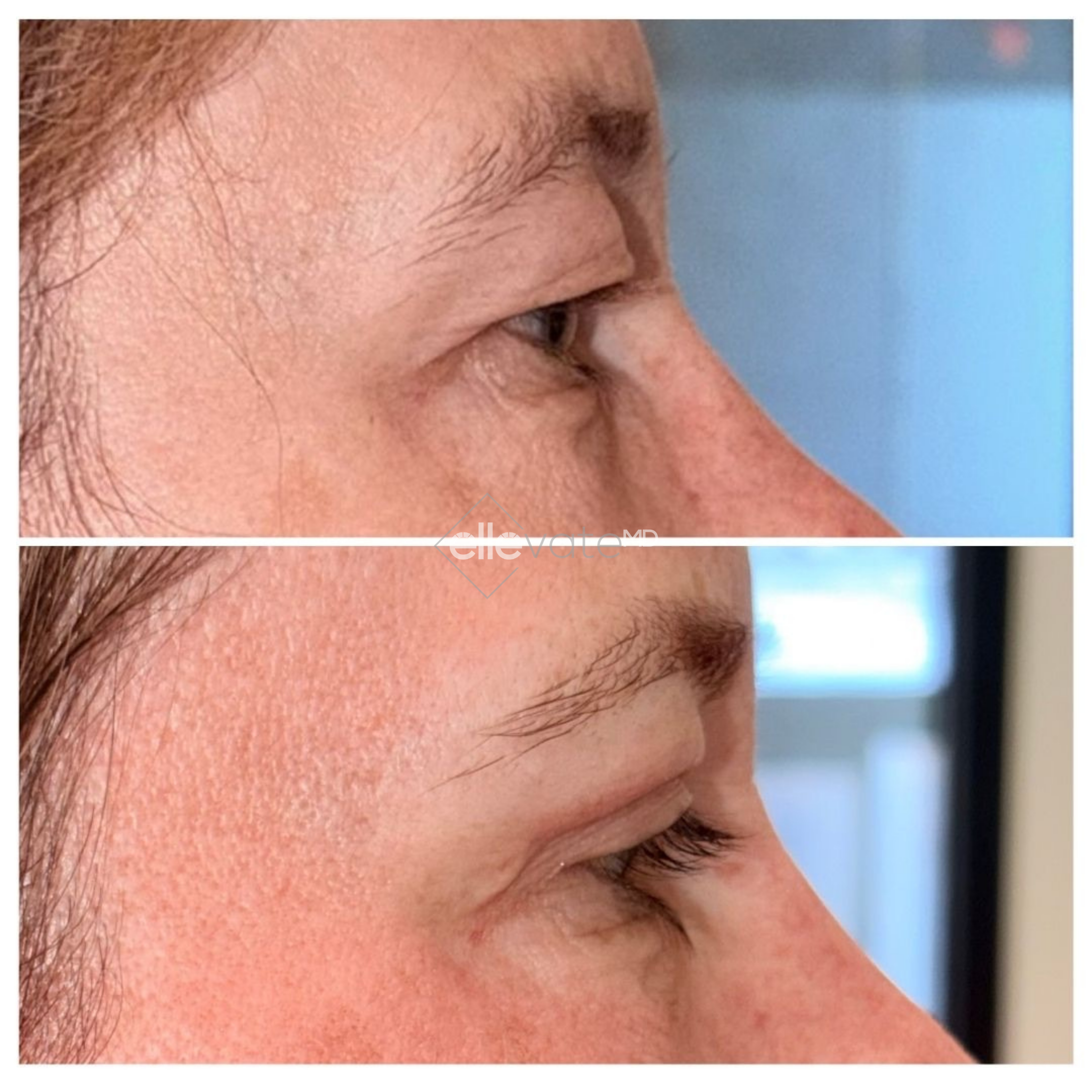 Before and after profile view of upper eyelid lift showing elevated lid position
