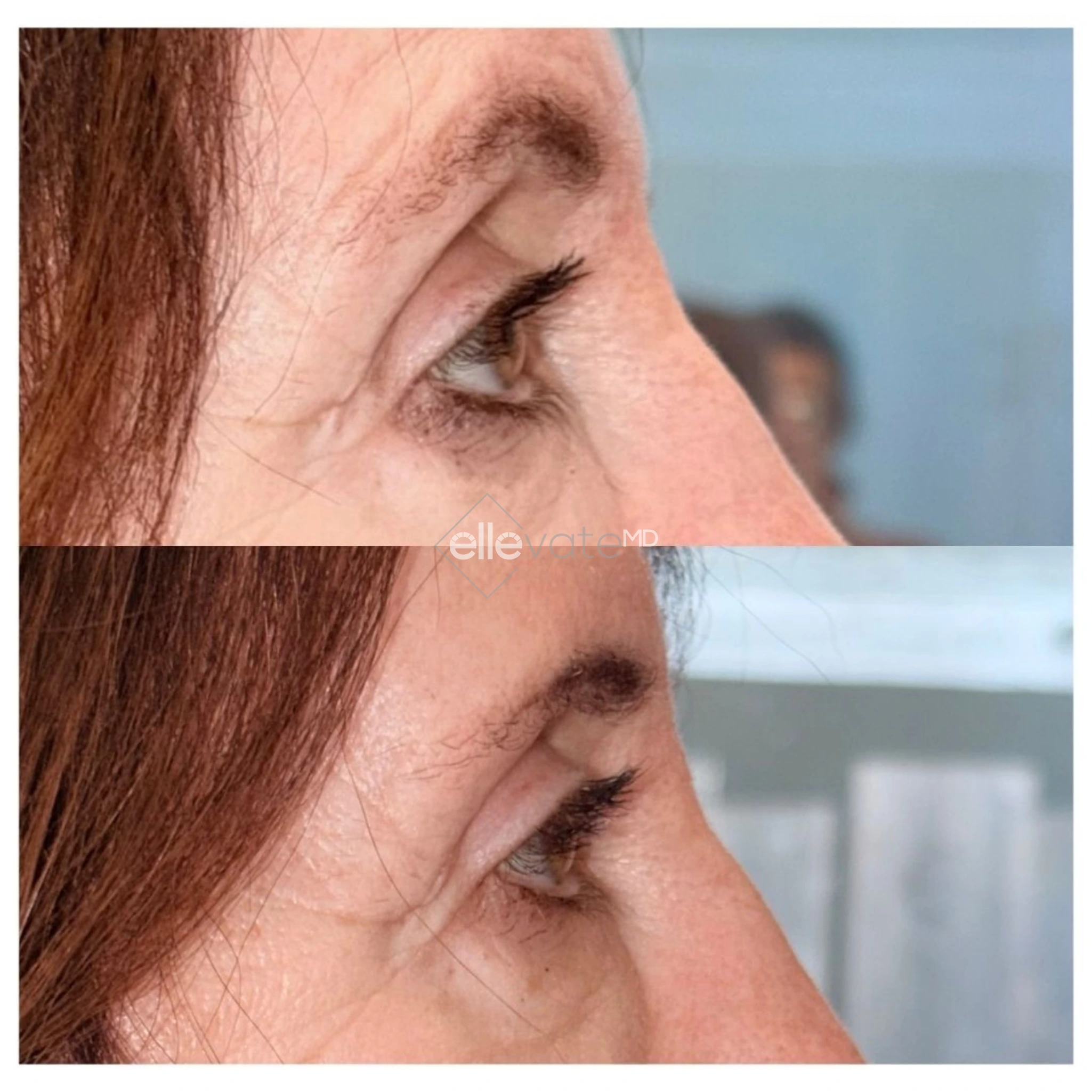 Before and after profile view of upper eyelid lift demonstrating eyelid rejuvenation