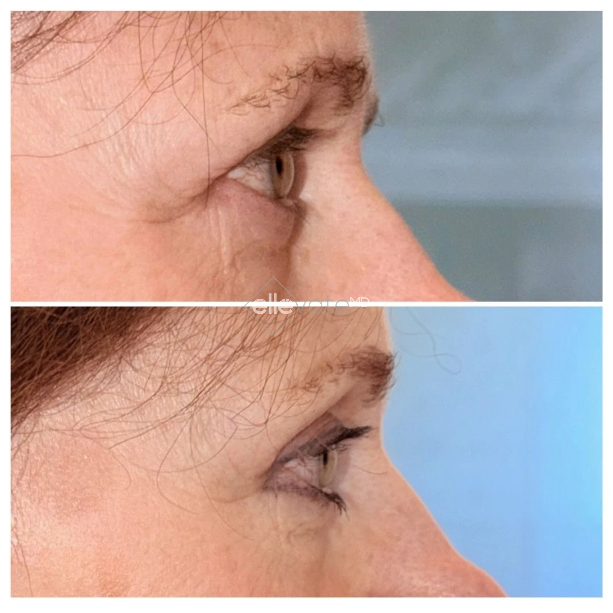 Before and after profile view of upper eyelid lift showing refined eye area