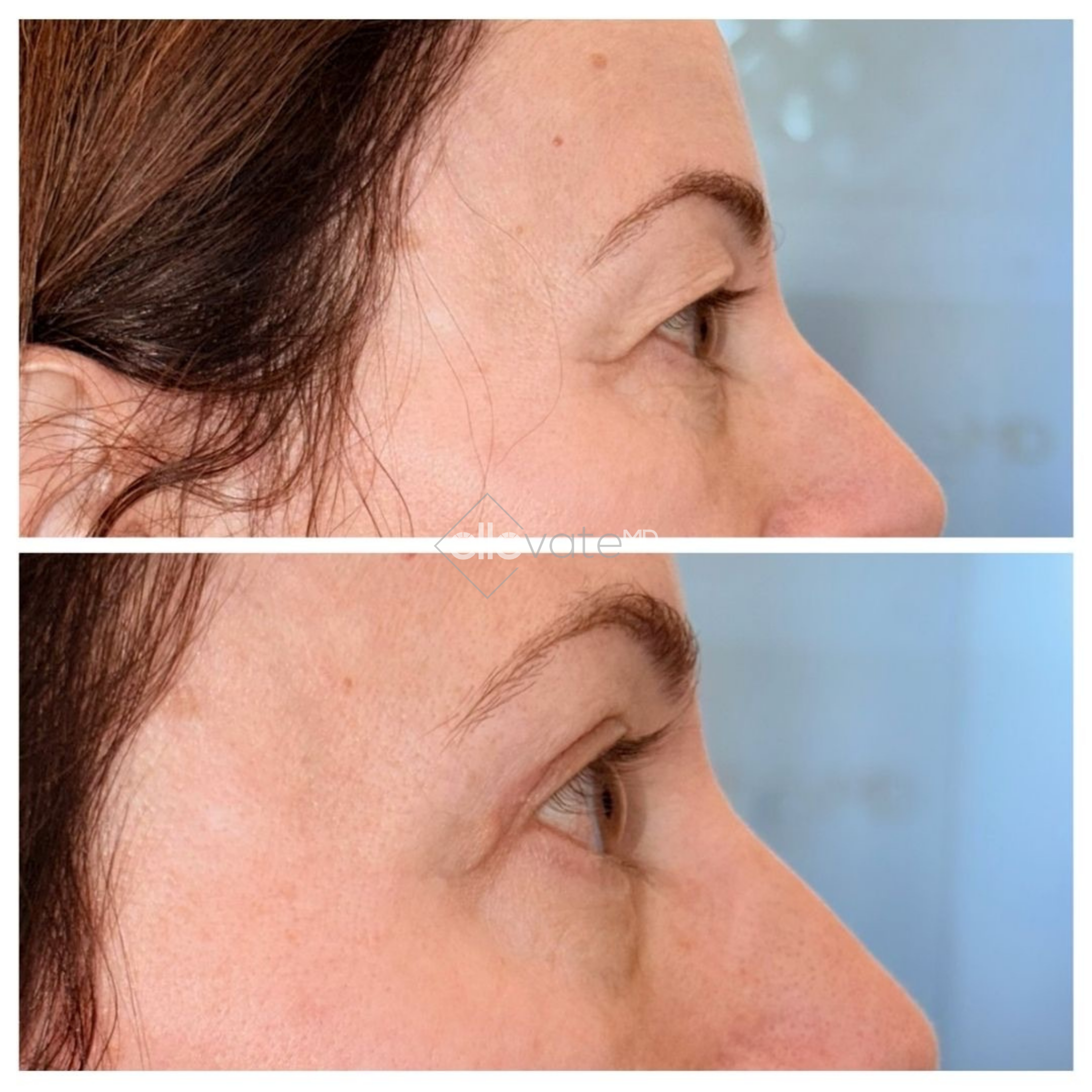Before and after profile view of upper eyelid lift displaying lifted eyelid appearance