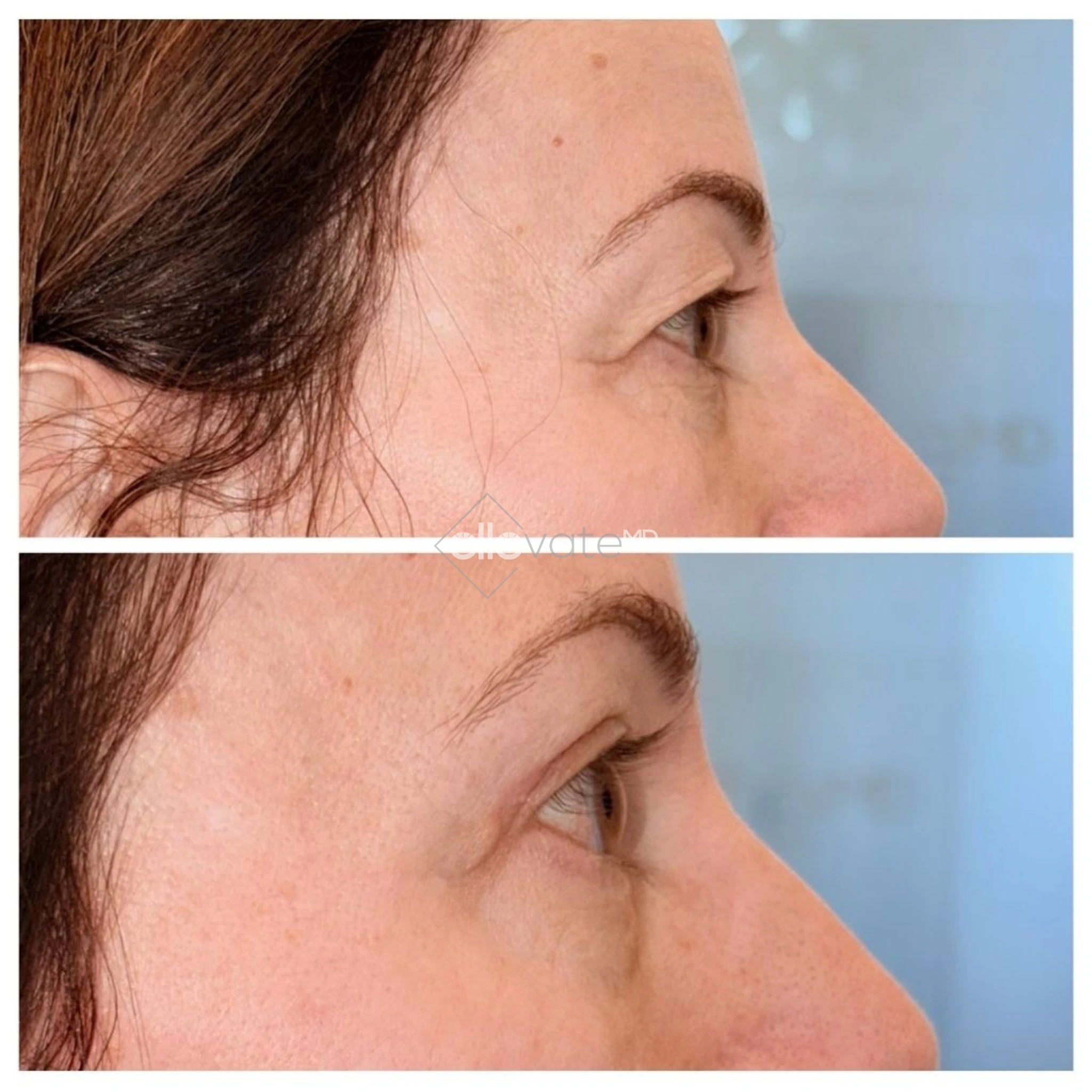 Before and after profile view of upper eyelid lift displaying lifted eyelid appearance