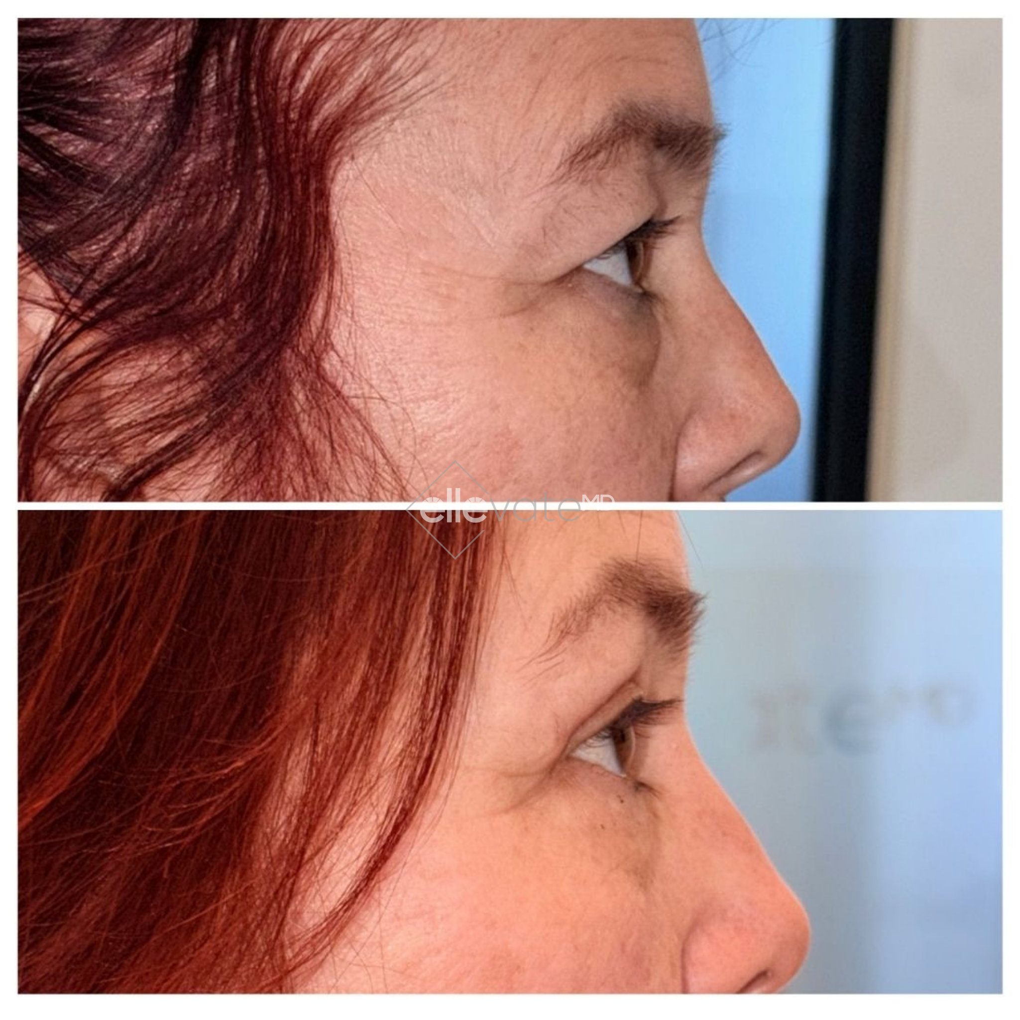Before and after profile view of upper eyelid lift showing improved eyelid definition