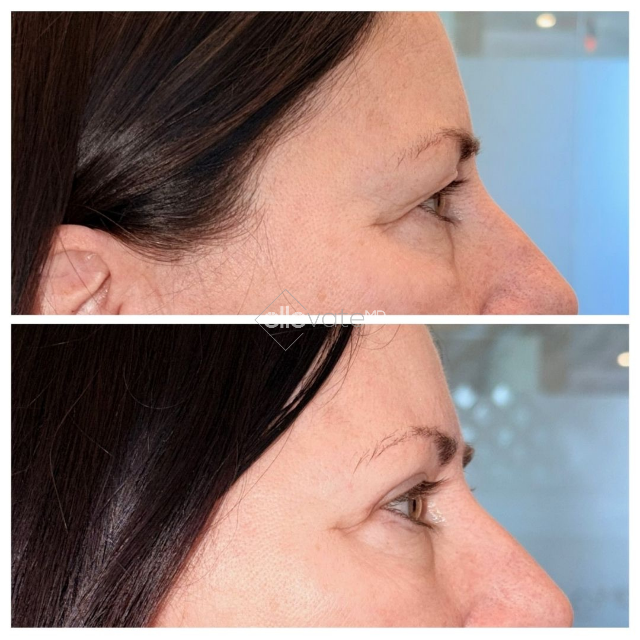 Before and after profile view showing upper eyelid lift results with improved upper lid contour